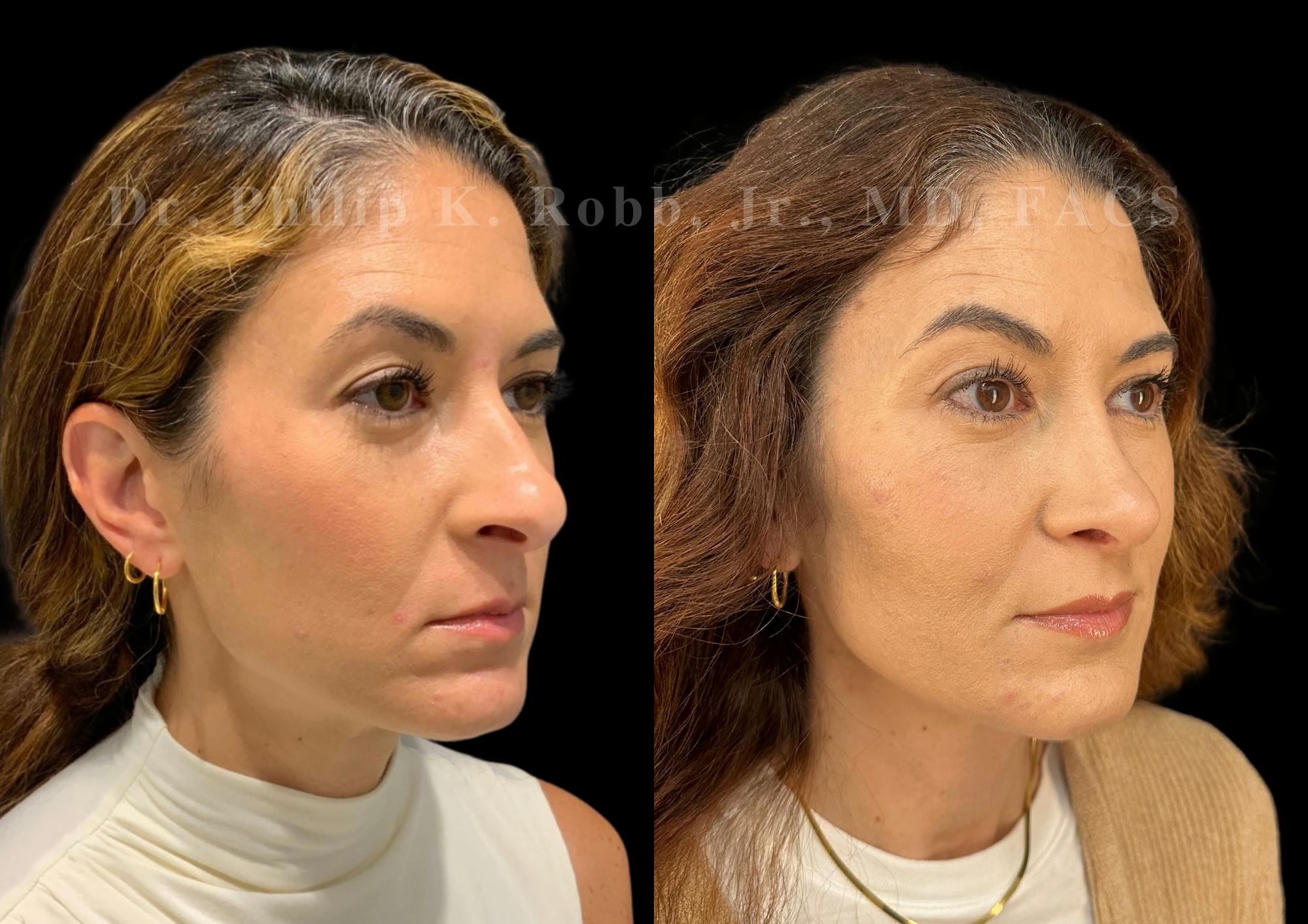 Ultrasonic Rhinoplasty Before & After Gallery - Patient 330936 - Image 2