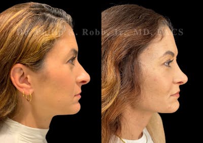 Ultrasonic Rhinoplasty Before & After Gallery - Patient 330936 - Image 1