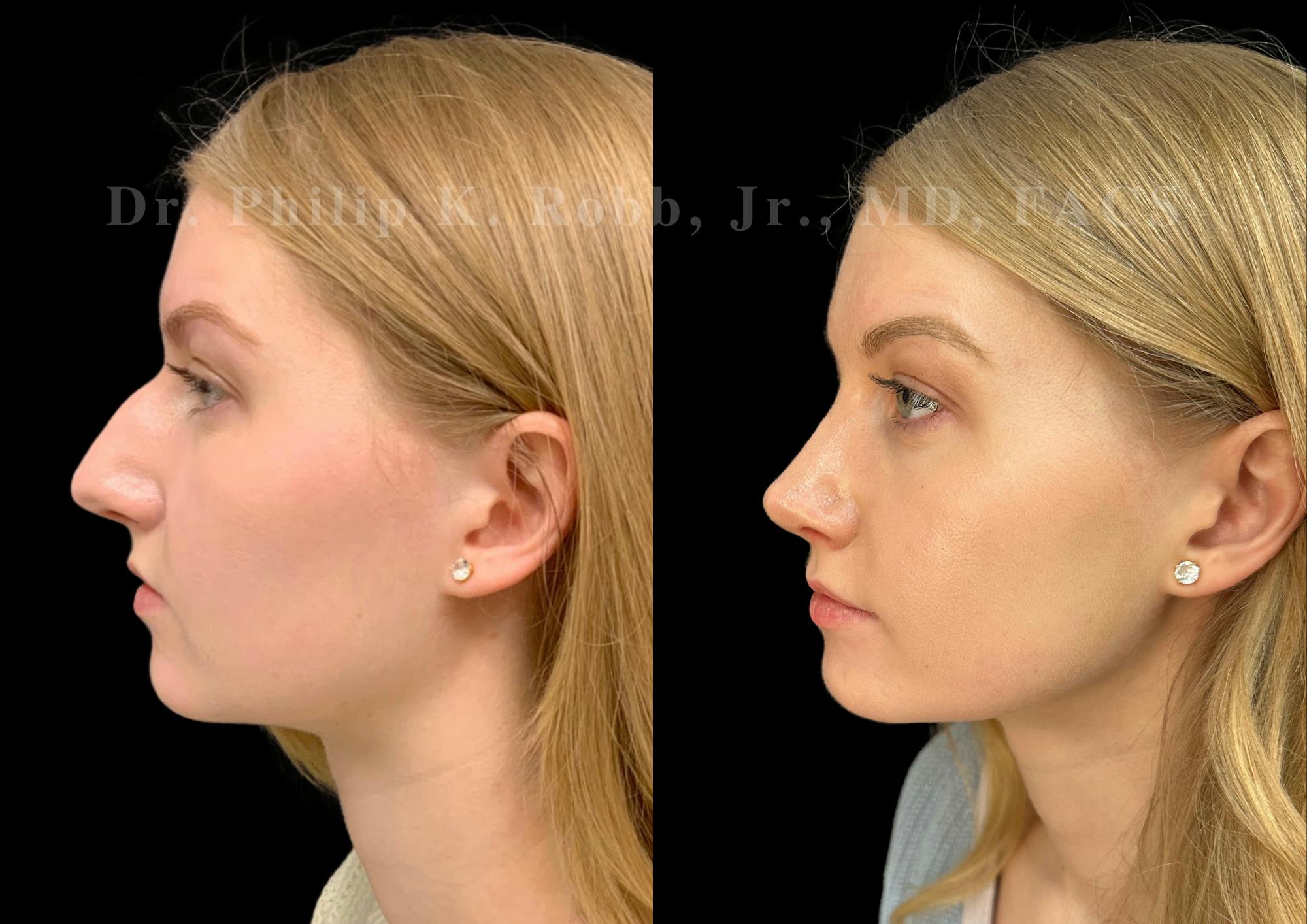 Ultrasonic Rhinoplasty Before & After Gallery - Patient 277496 - Image 5