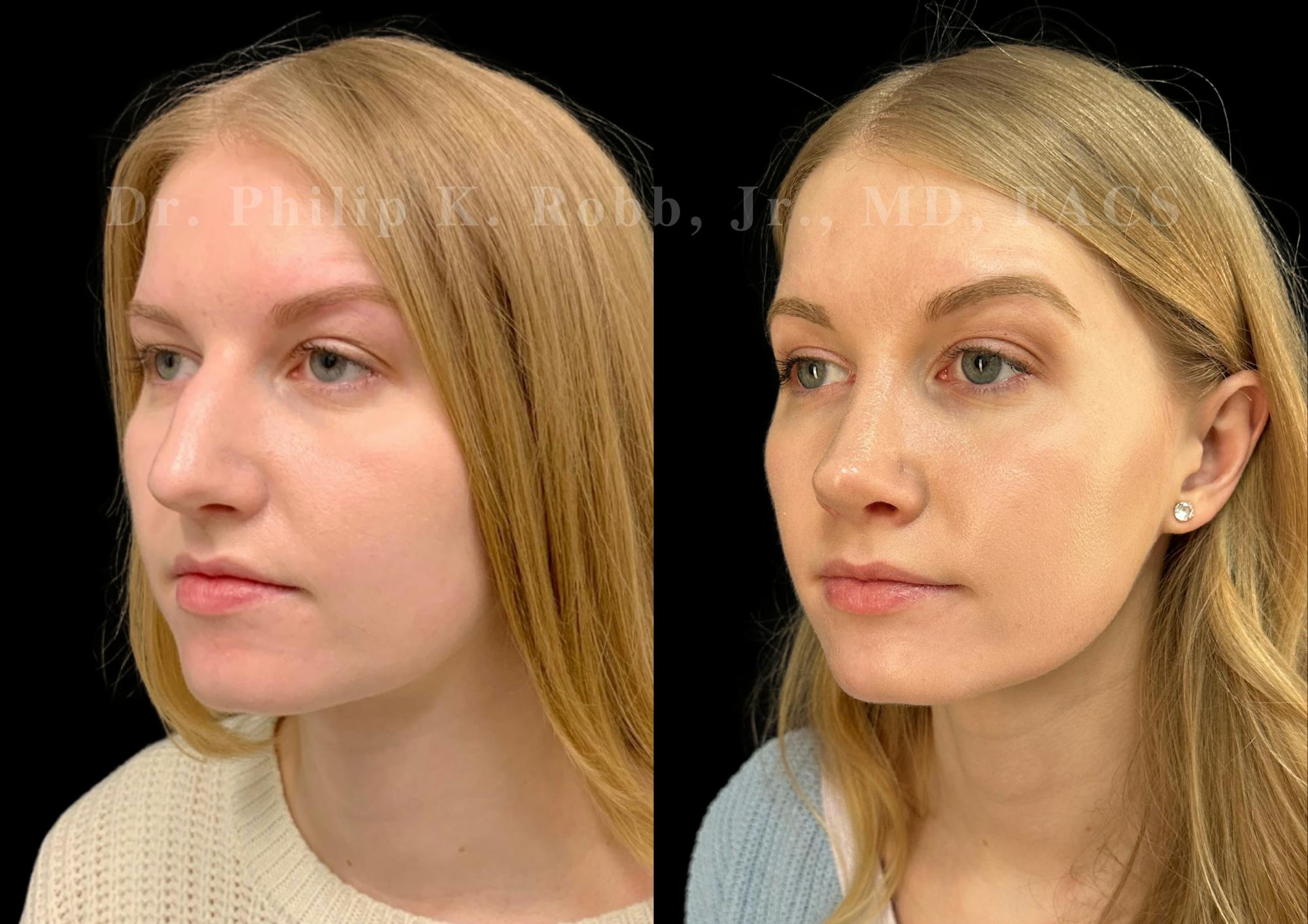 Ultrasonic Rhinoplasty Before & After Gallery - Patient 277496 - Image 4