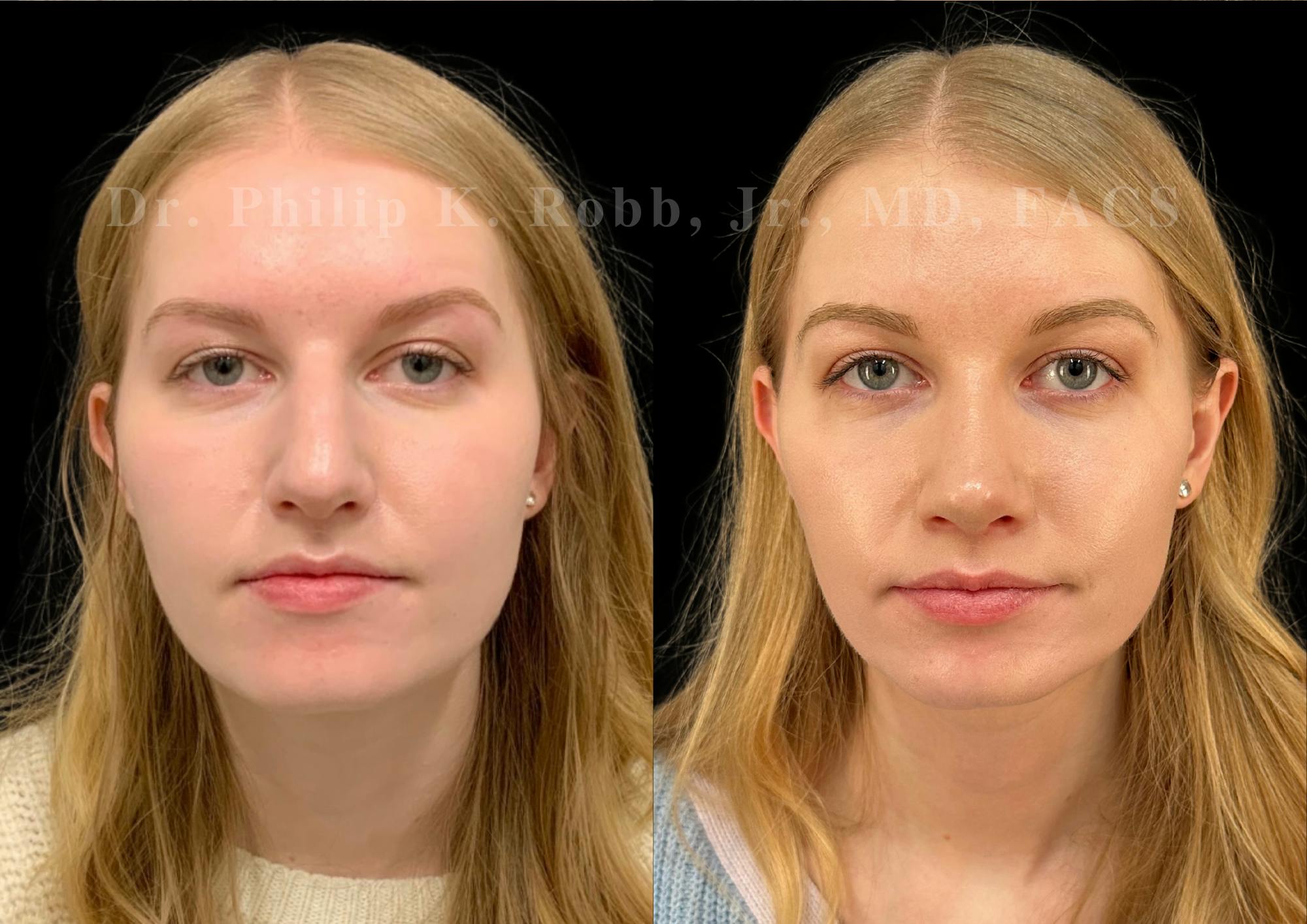 Ultrasonic Rhinoplasty Before & After Gallery - Patient 277496 - Image 3