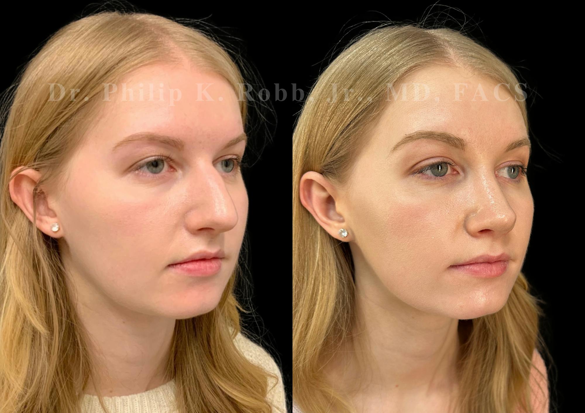 Ultrasonic Rhinoplasty Before & After Gallery - Patient 277496 - Image 2