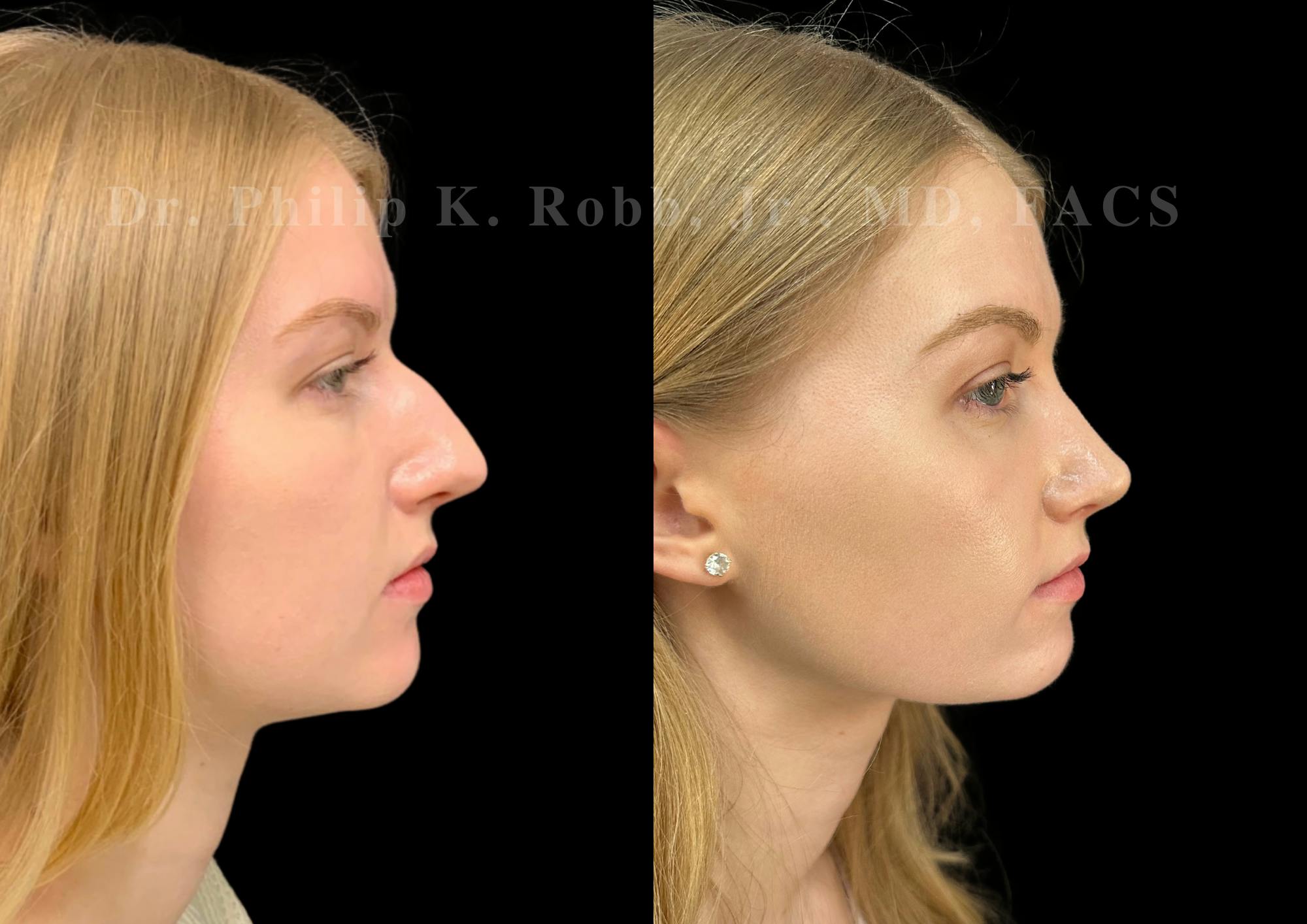 Ultrasonic Rhinoplasty Before & After Gallery - Patient 277496 - Image 1