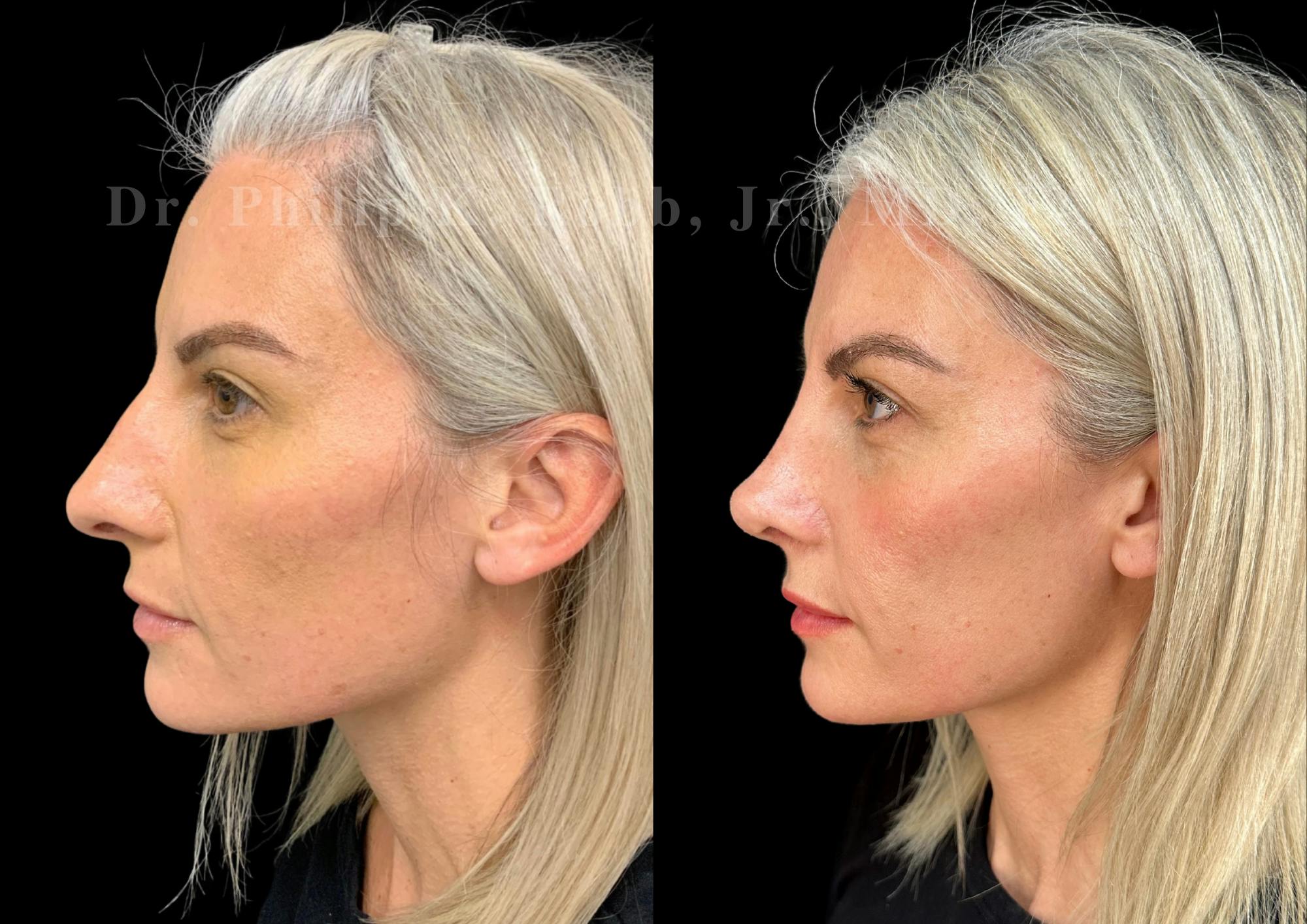 Ultrasonic Rhinoplasty Before & After Gallery - Patient 254952 - Image 5