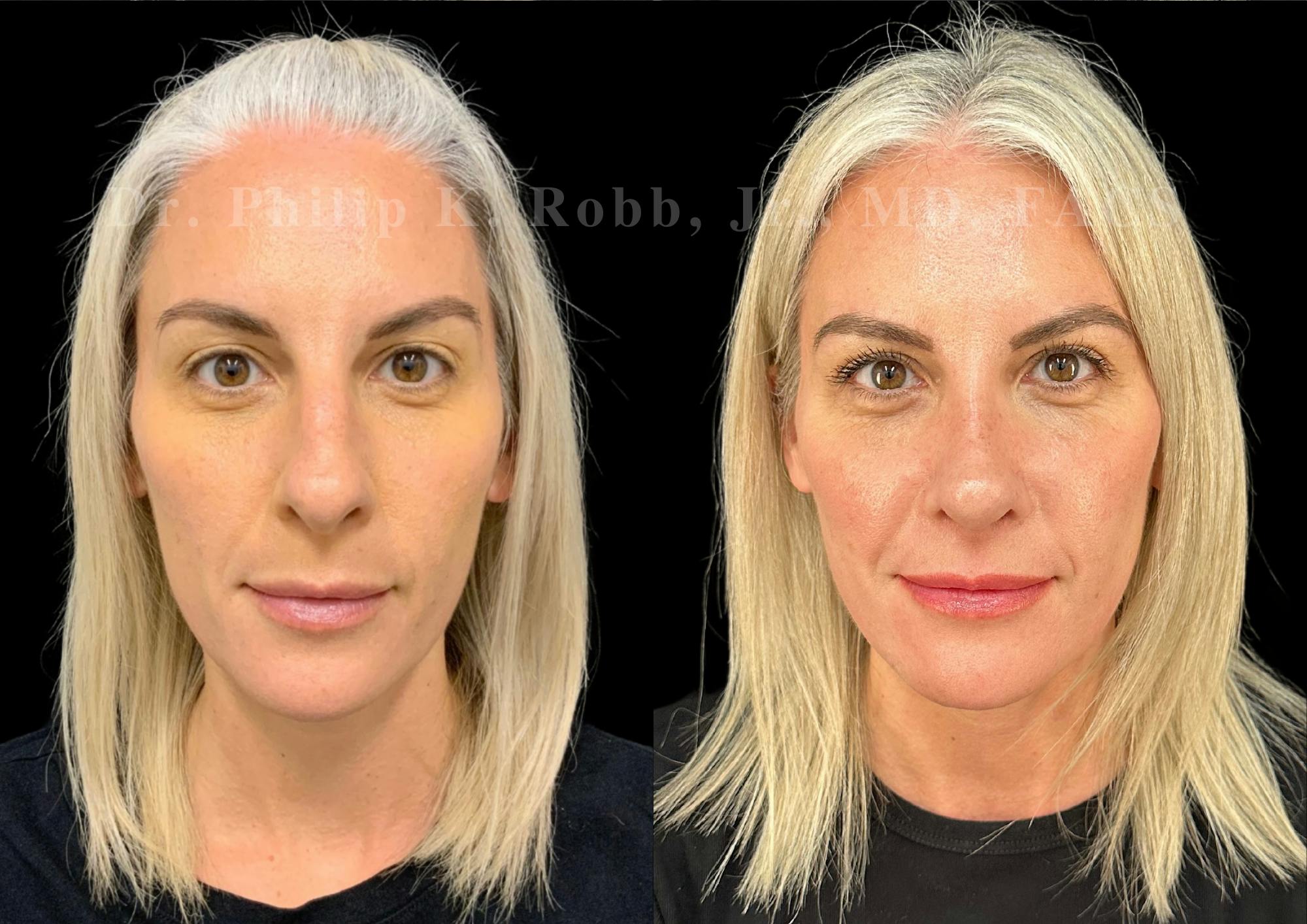 Ultrasonic Rhinoplasty Before & After Gallery - Patient 254952 - Image 3