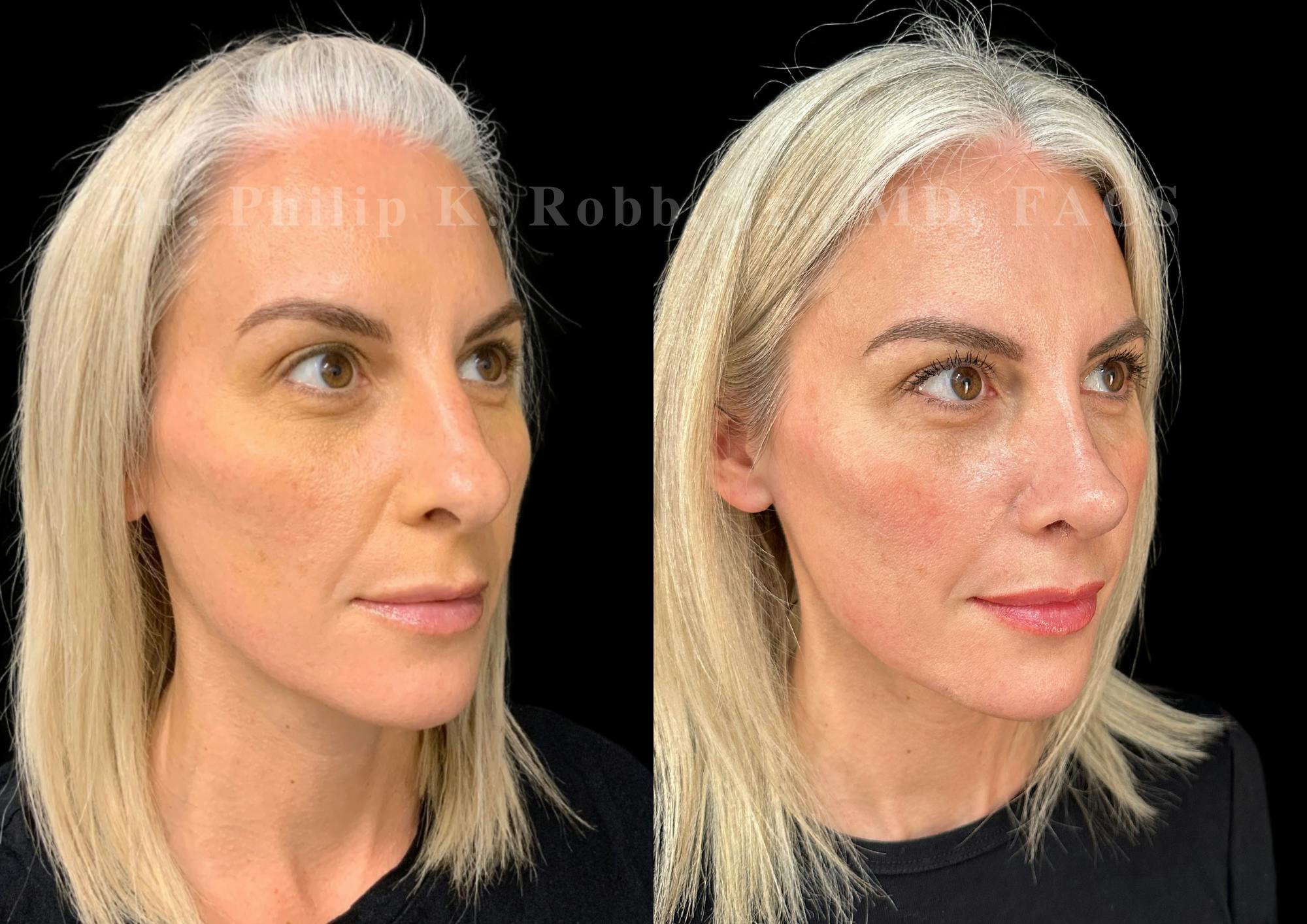 Ultrasonic Rhinoplasty Before & After Gallery - Patient 254952 - Image 2