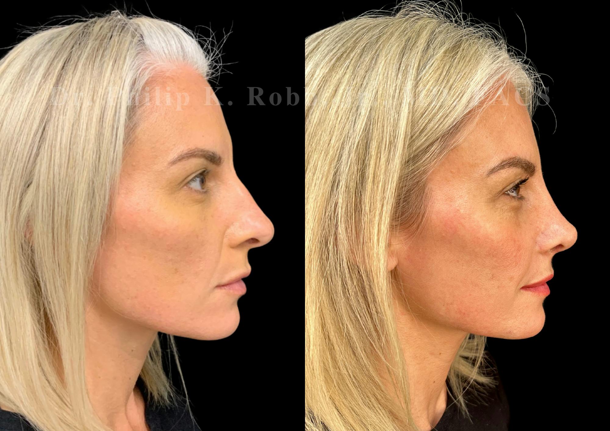 Ultrasonic Rhinoplasty Before & After Gallery - Patient 254952 - Image 1