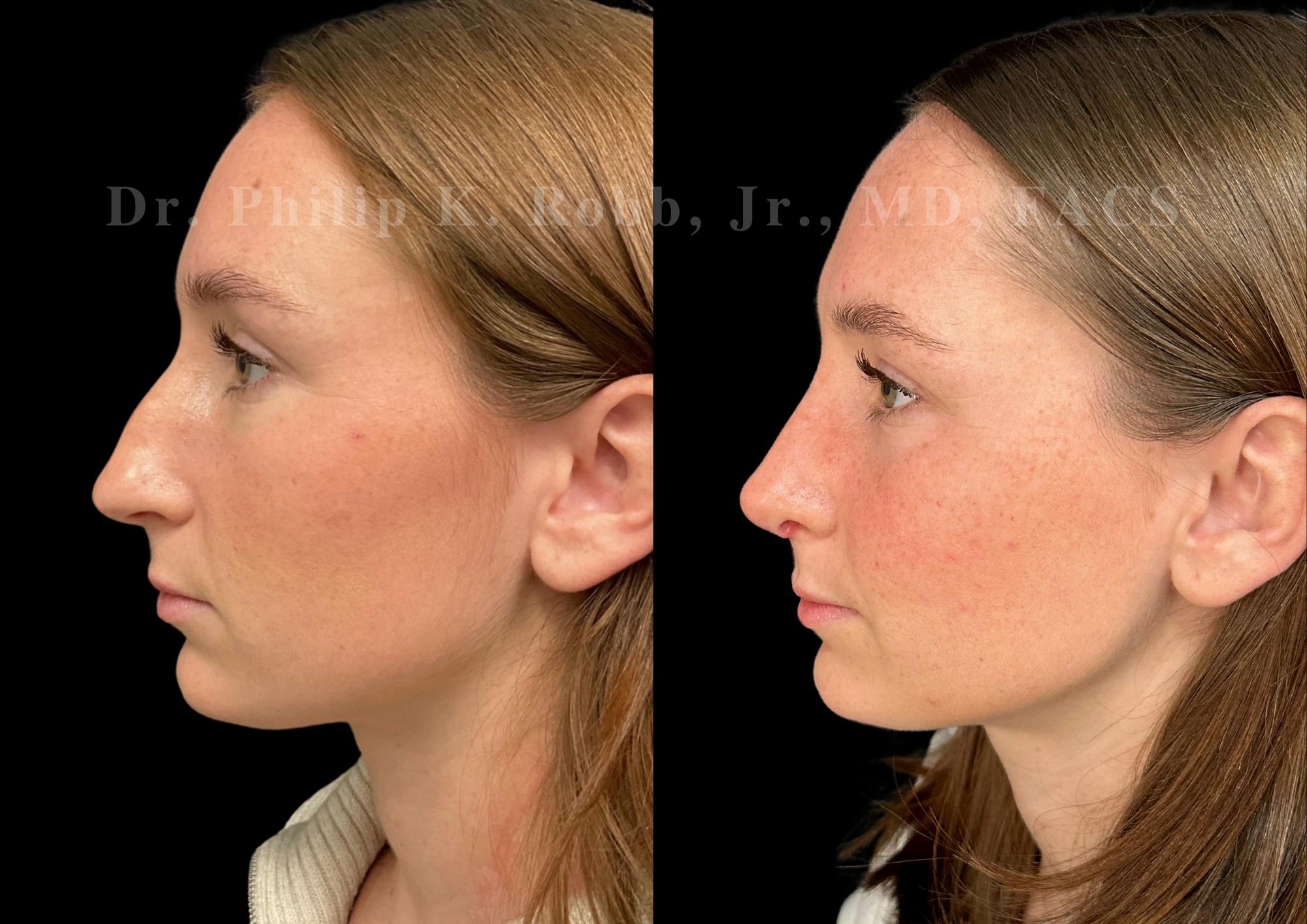 Ultrasonic Rhinoplasty Before & After Gallery - Patient 131870 - Image 5