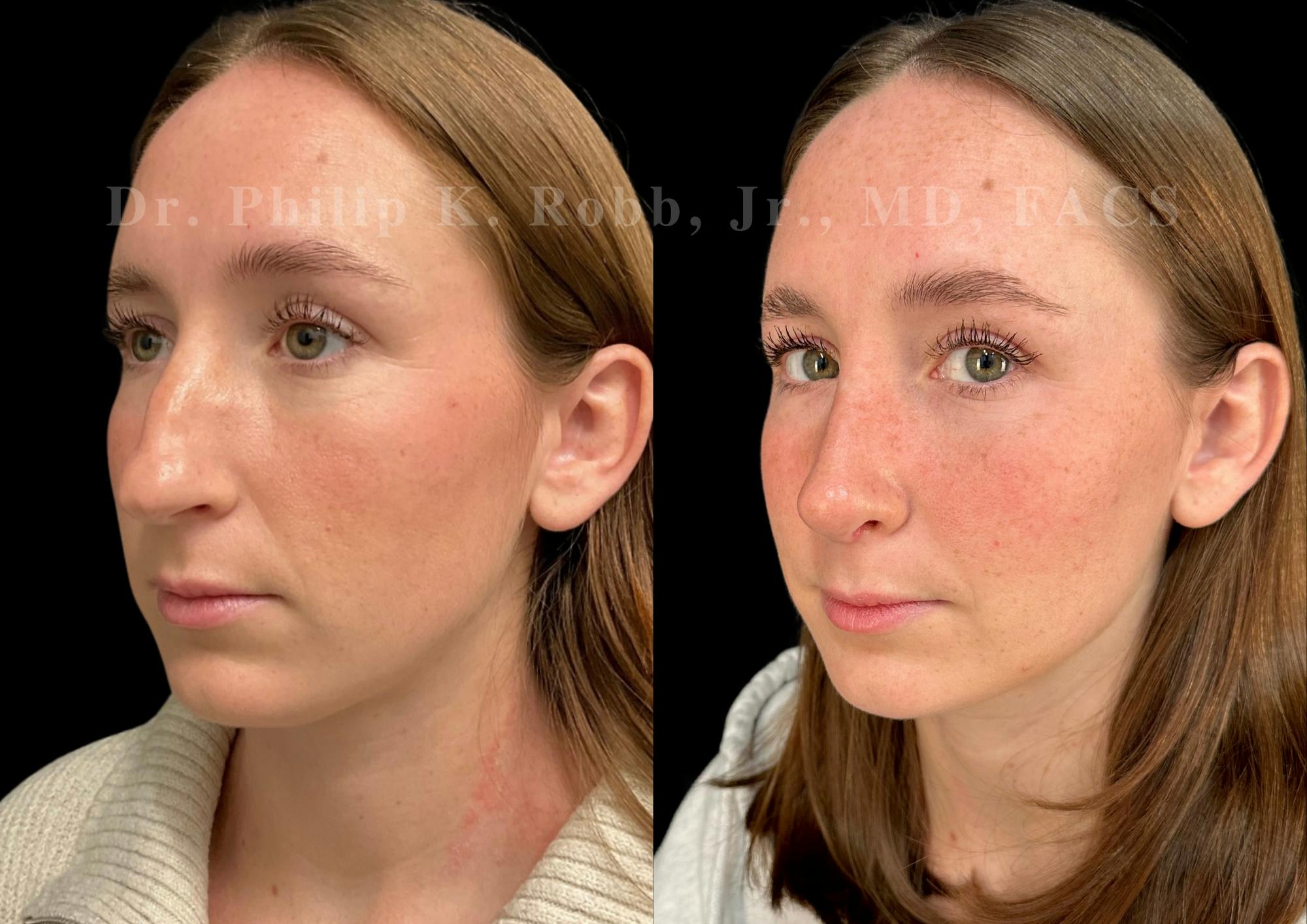 Ultrasonic Rhinoplasty Before & After Gallery - Patient 131870 - Image 4