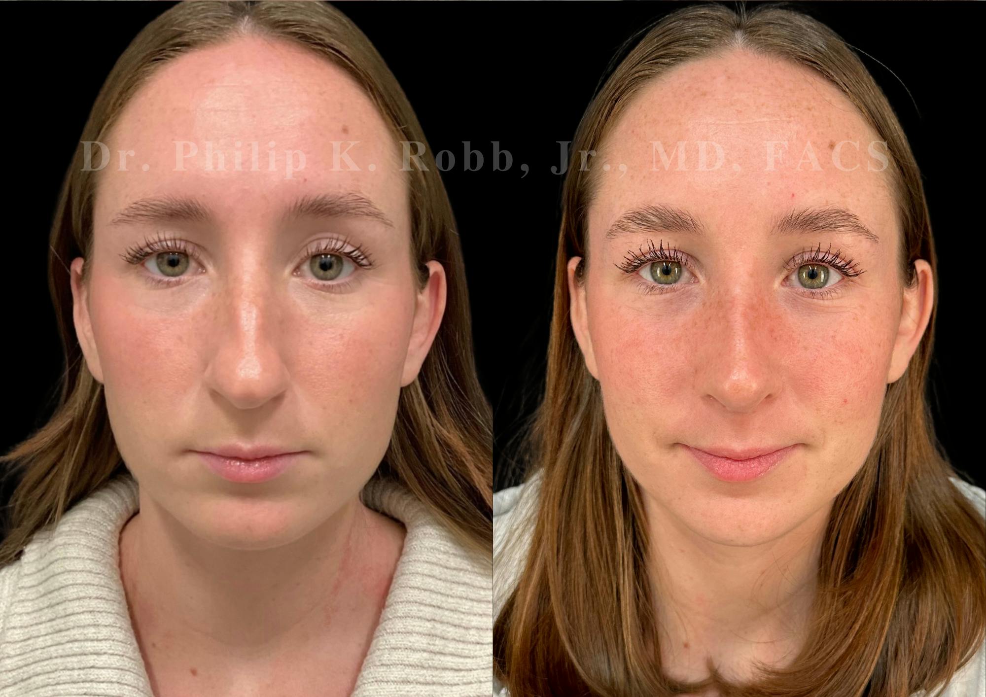 Ultrasonic Rhinoplasty Before & After Gallery - Patient 131870 - Image 3