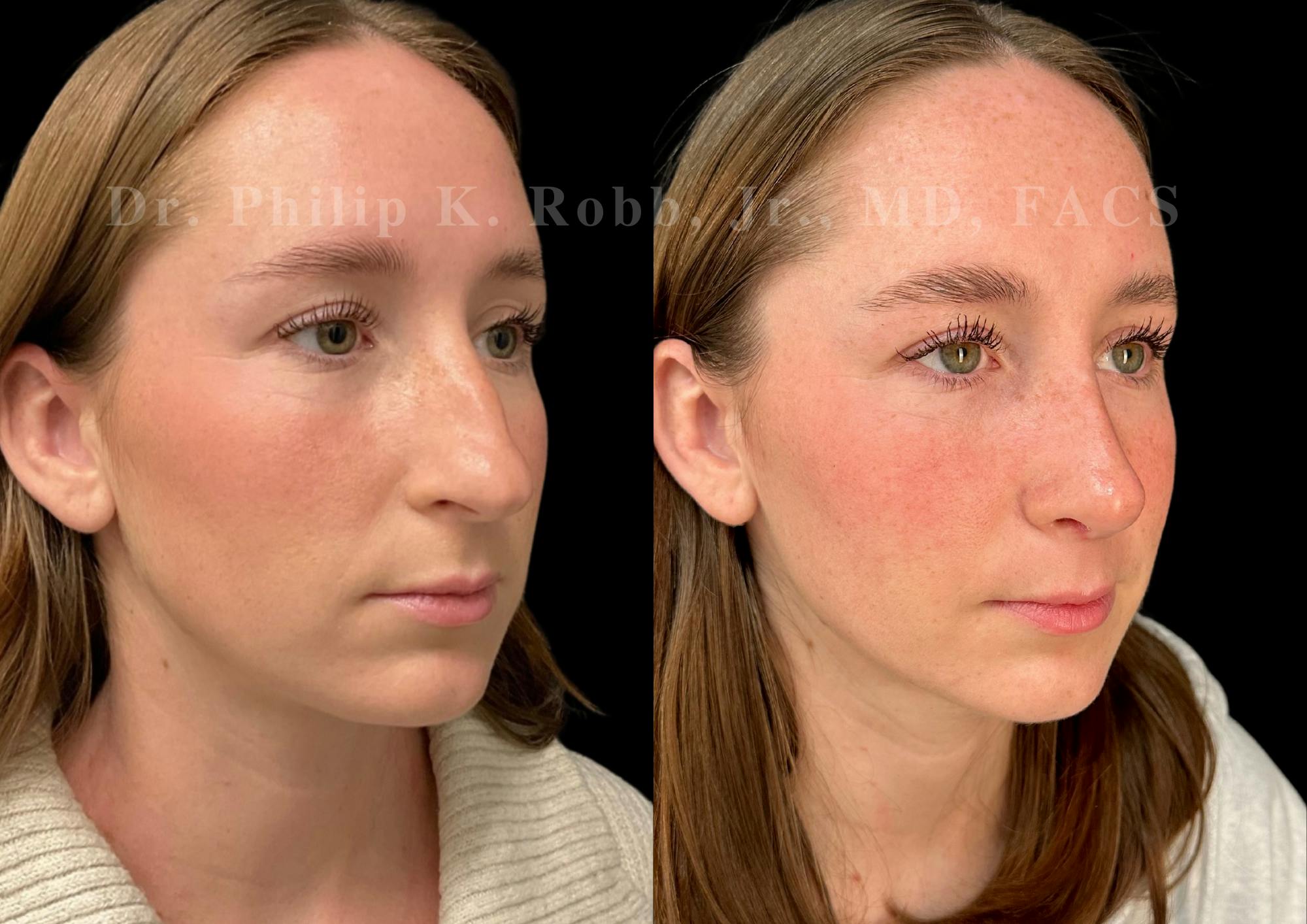 Ultrasonic Rhinoplasty Before & After Gallery - Patient 131870 - Image 2