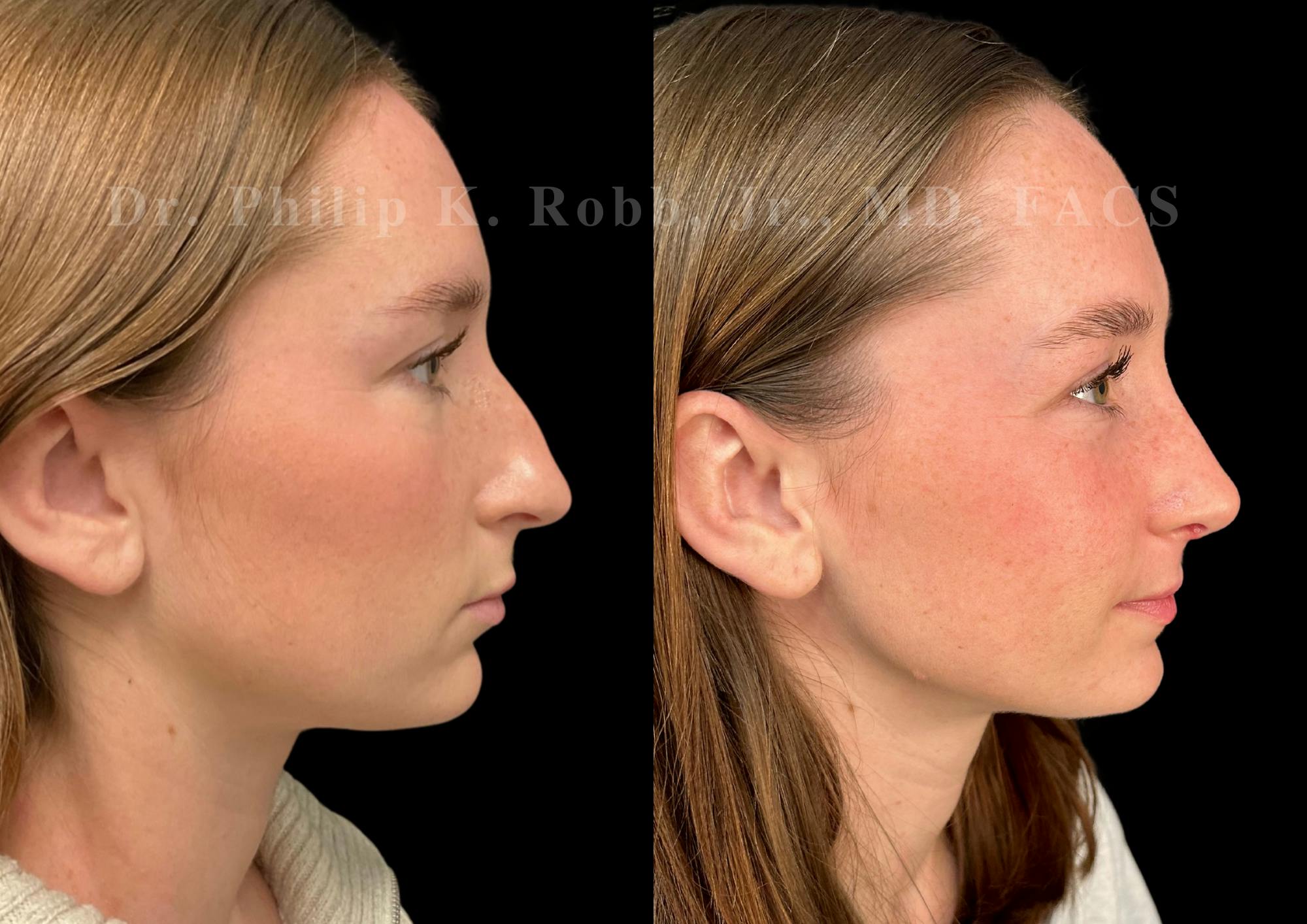 Ultrasonic Rhinoplasty Before & After Gallery - Patient 131870 - Image 1