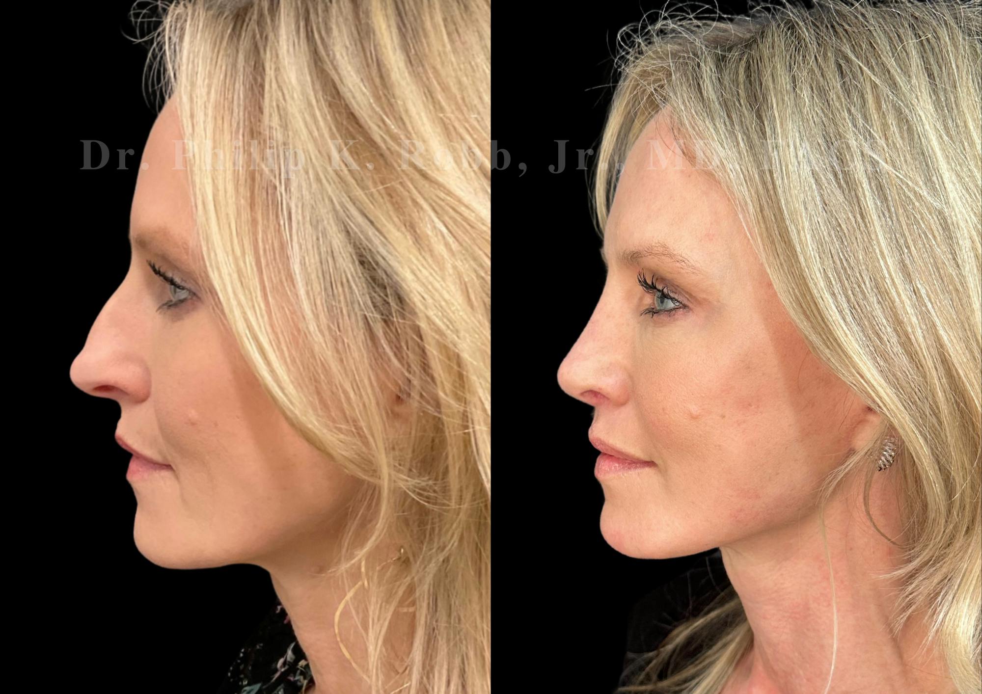 Ultrasonic Rhinoplasty Before & After Gallery - Patient 423440 - Image 5