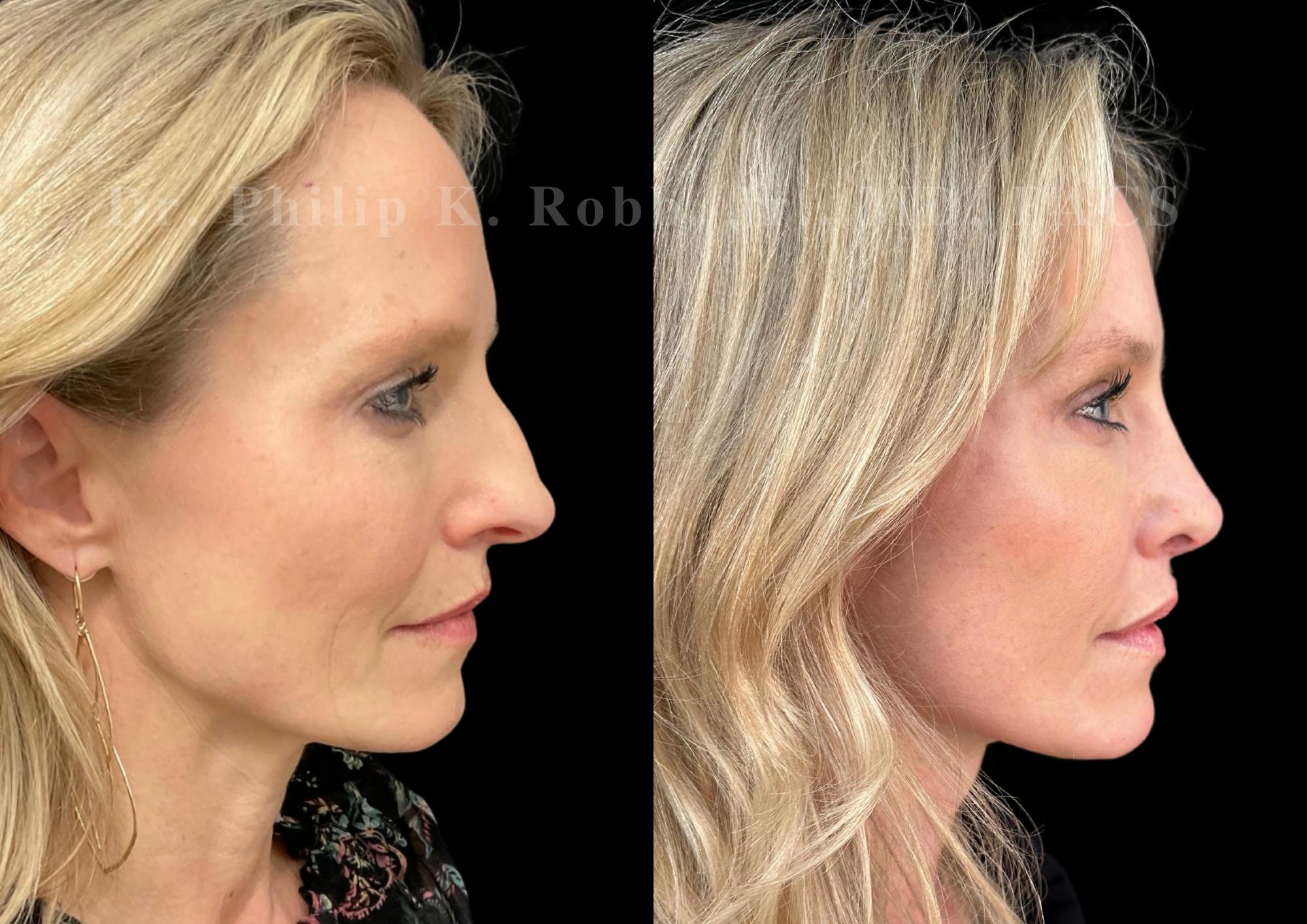 Ultrasonic Rhinoplasty Before & After Gallery - Patient 423440 - Image 1