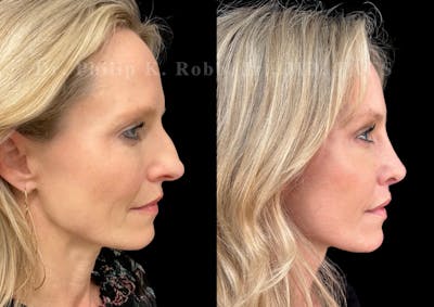 Ultrasonic Rhinoplasty Before & After Gallery - Patient 423440 - Image 1