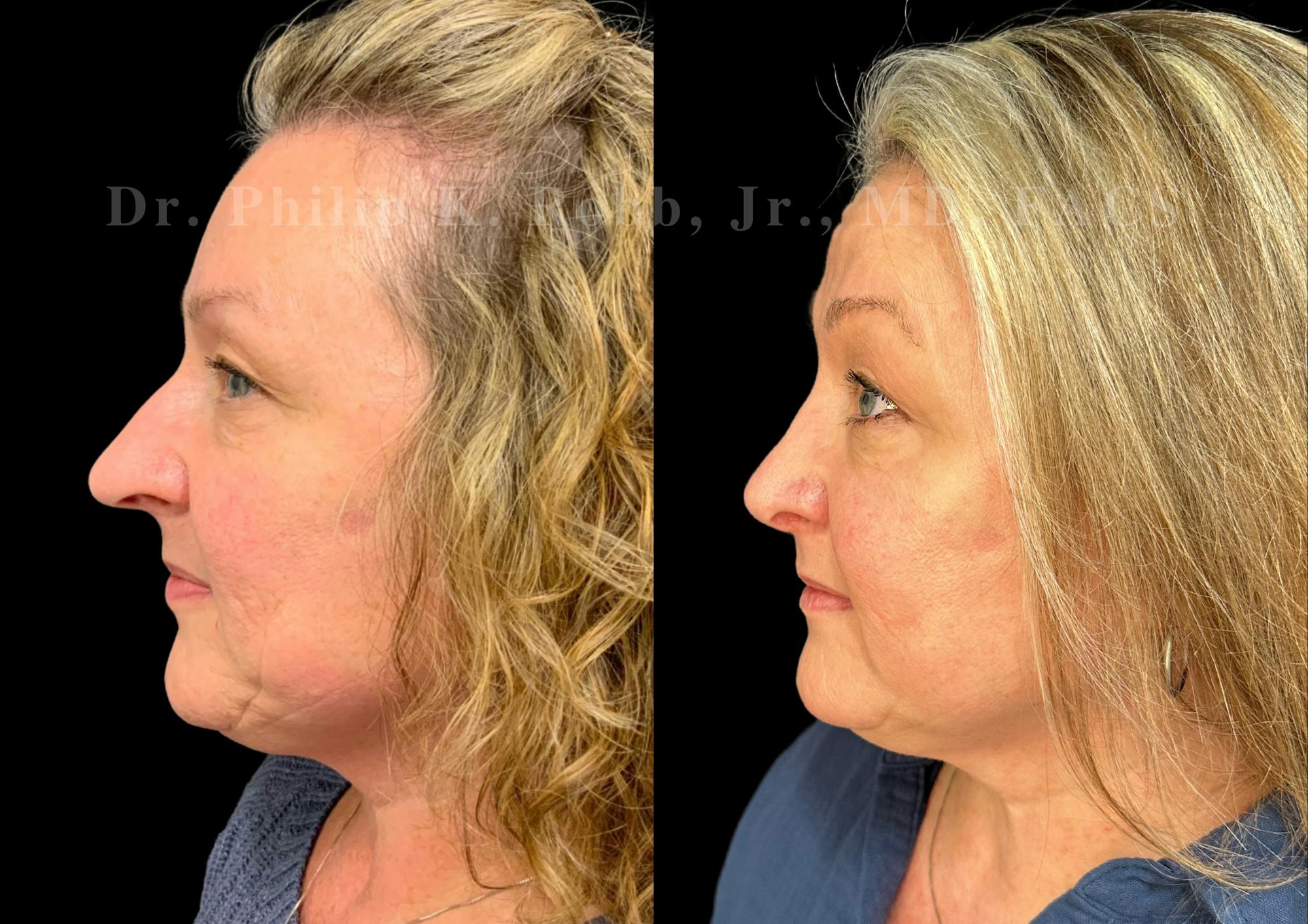 Ultrasonic Rhinoplasty Before & After Gallery - Patient 286073 - Image 5