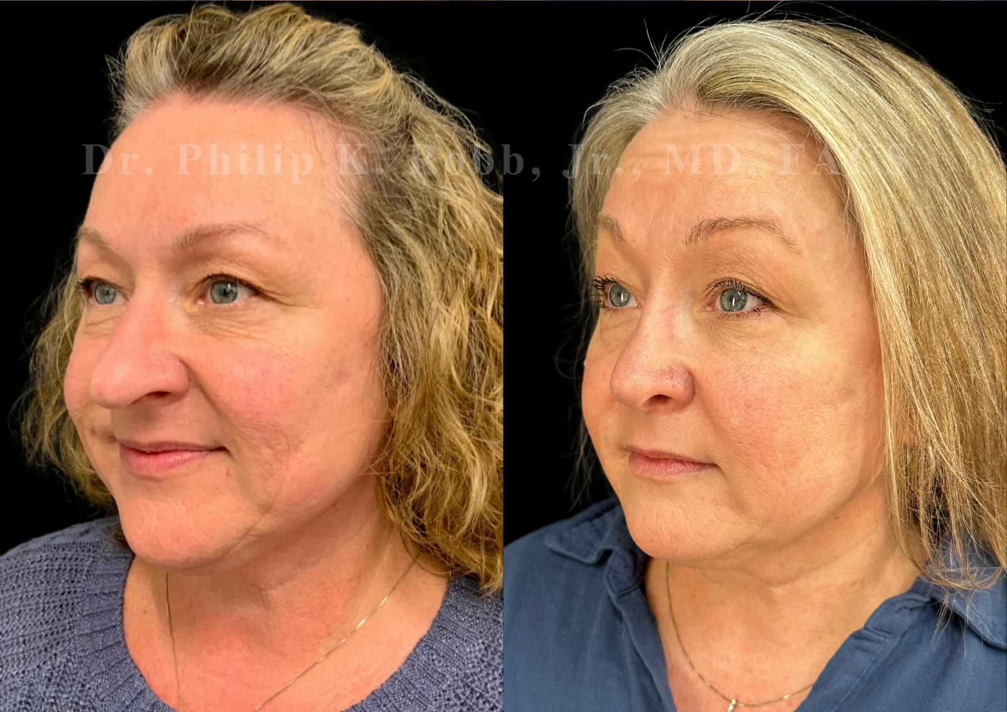 Ultrasonic Rhinoplasty Before & After Gallery - Patient 286073 - Image 4