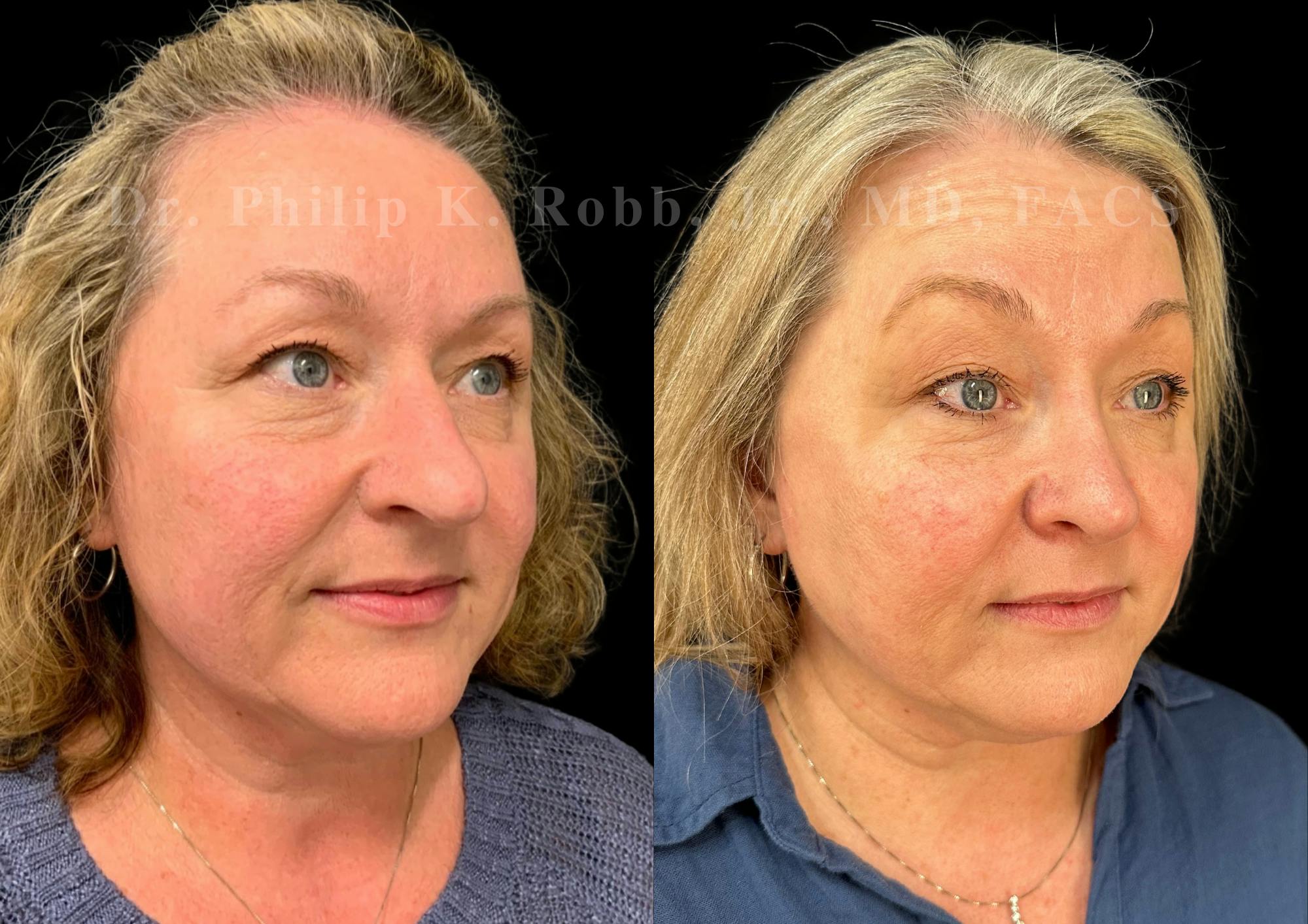 Ultrasonic Rhinoplasty Before & After Gallery - Patient 286073 - Image 2