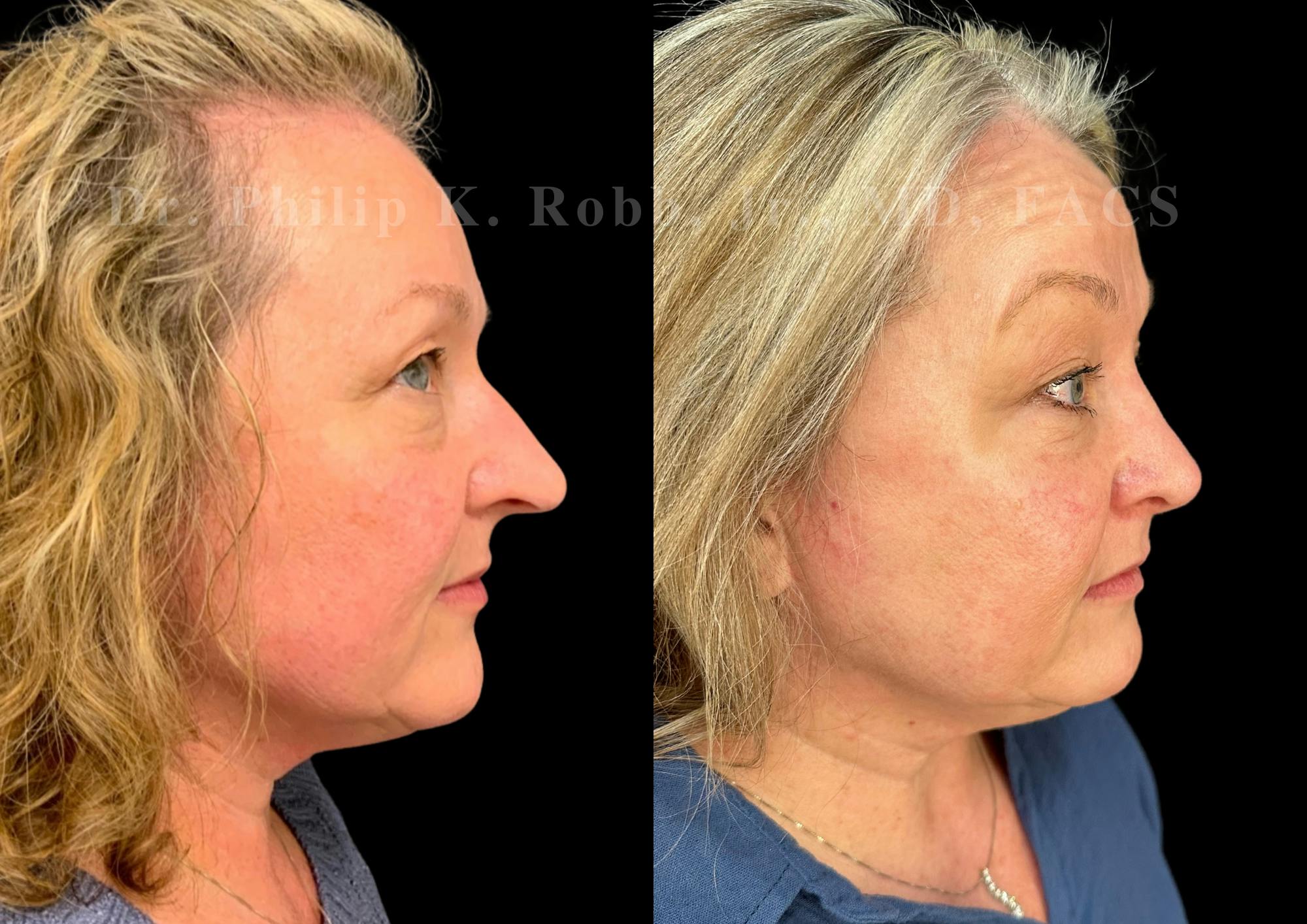 Ultrasonic Rhinoplasty Before & After Gallery - Patient 286073 - Image 1