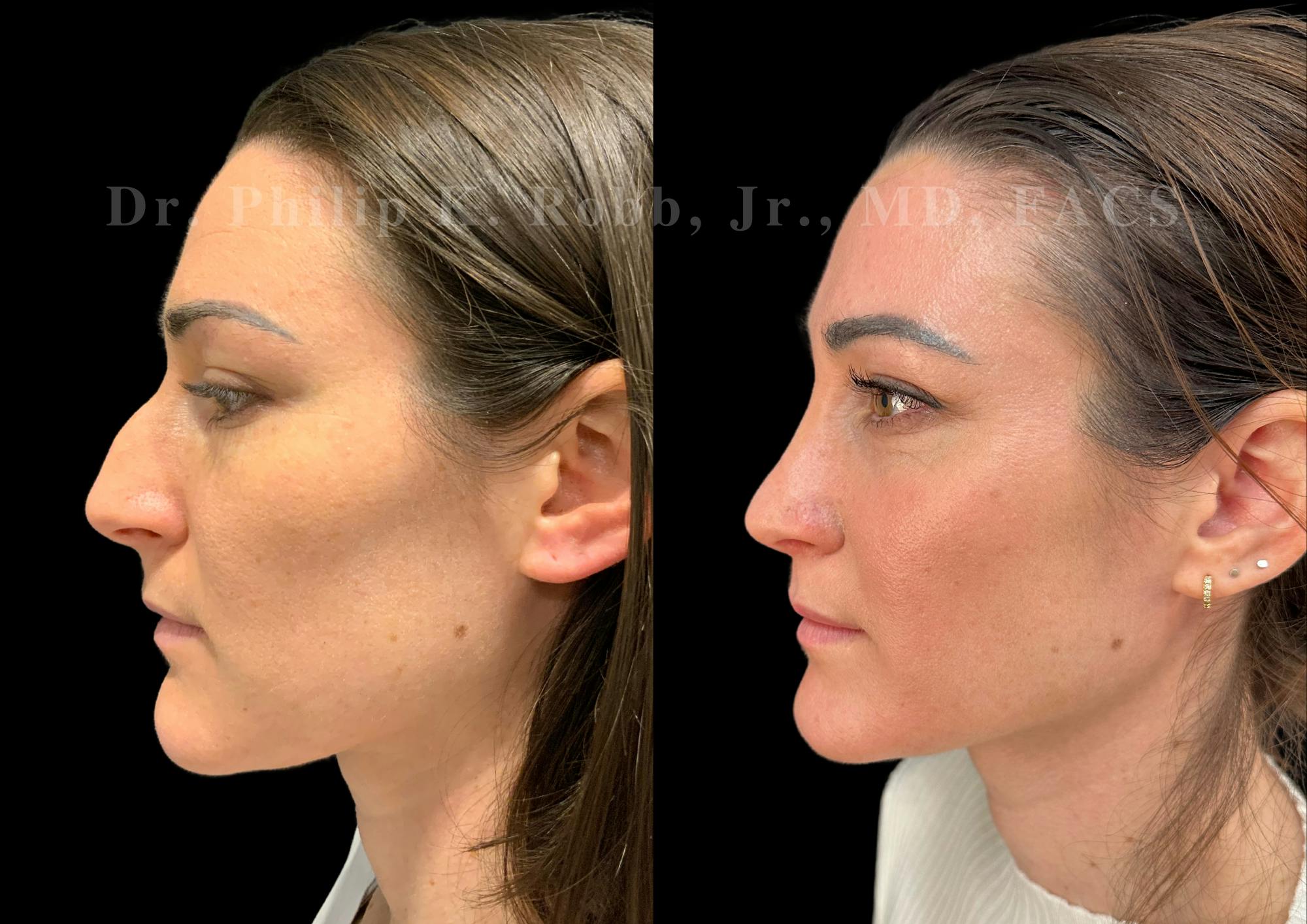 Ultrasonic Rhinoplasty Before & After Gallery - Patient 118095 - Image 5