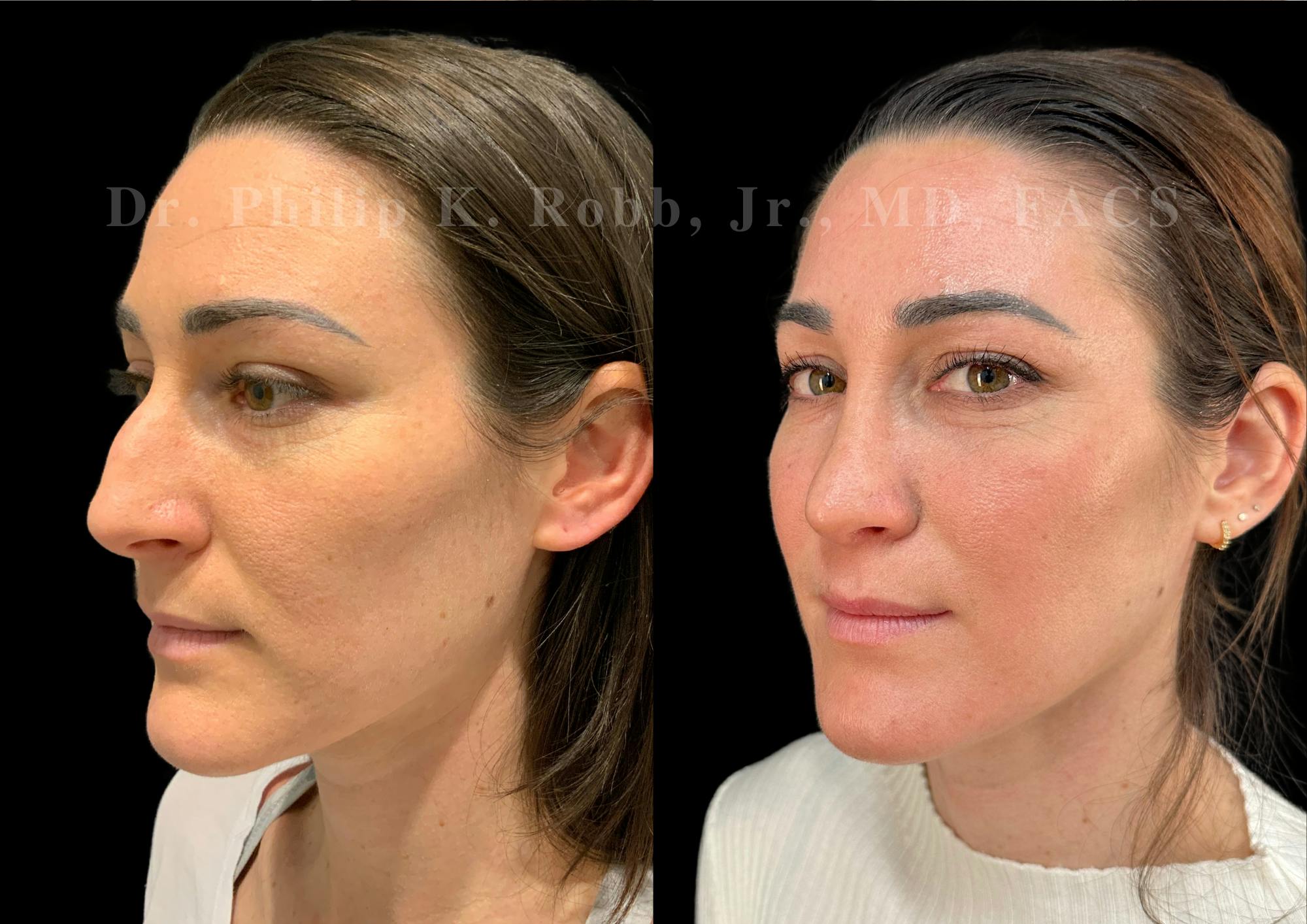 Ultrasonic Rhinoplasty Before & After Gallery - Patient 118095 - Image 4