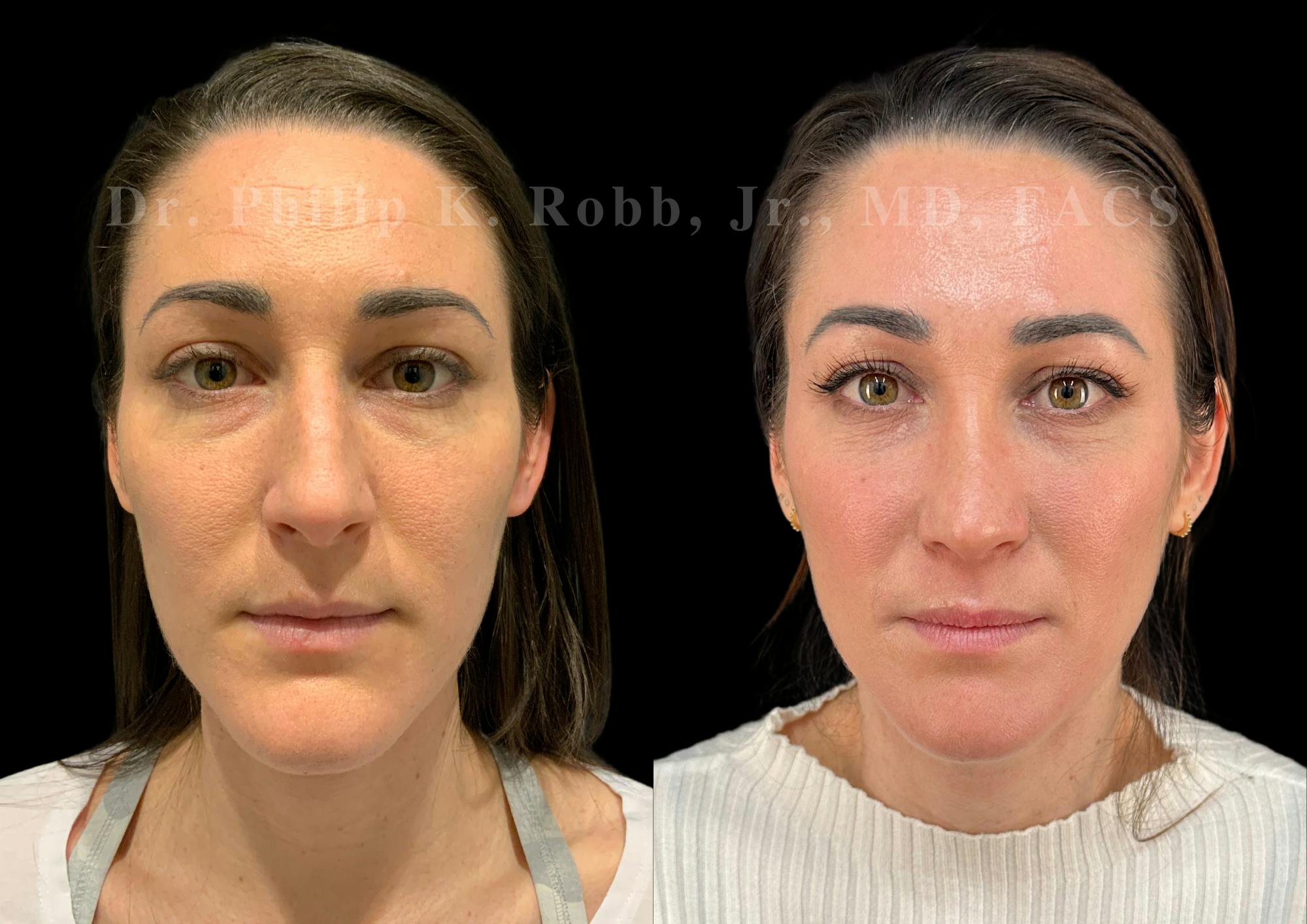 Ultrasonic Rhinoplasty Before & After Gallery - Patient 118095 - Image 3