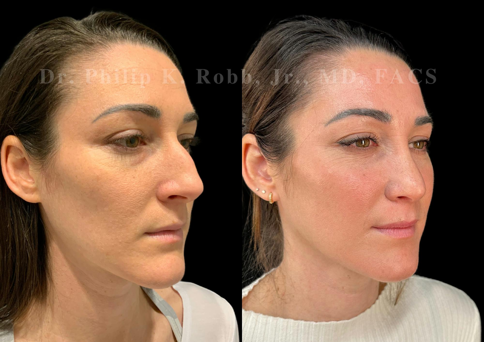 Ultrasonic Rhinoplasty Before & After Gallery - Patient 118095 - Image 2