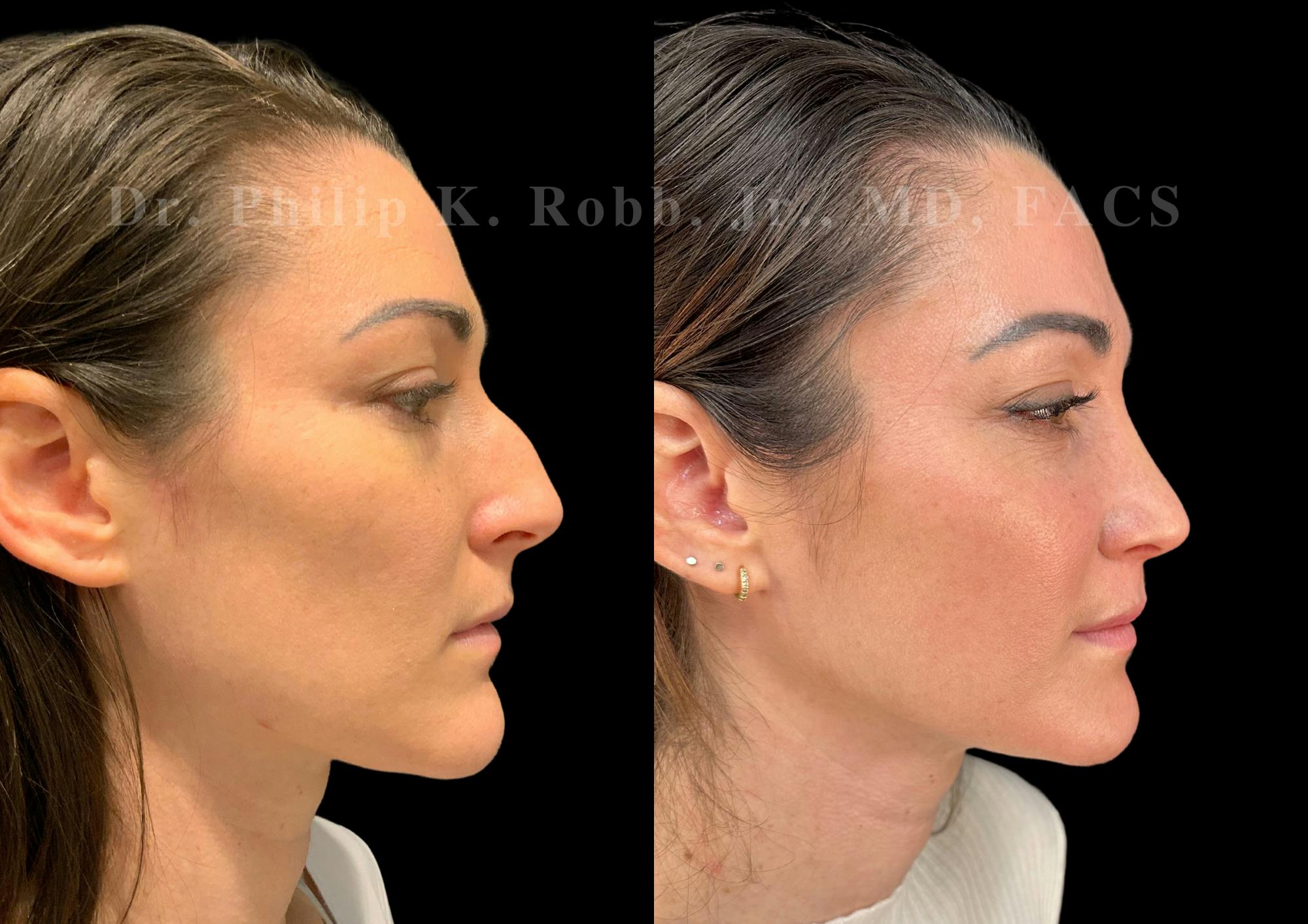 Ultrasonic Rhinoplasty Before & After Gallery - Patient 118095 - Image 1
