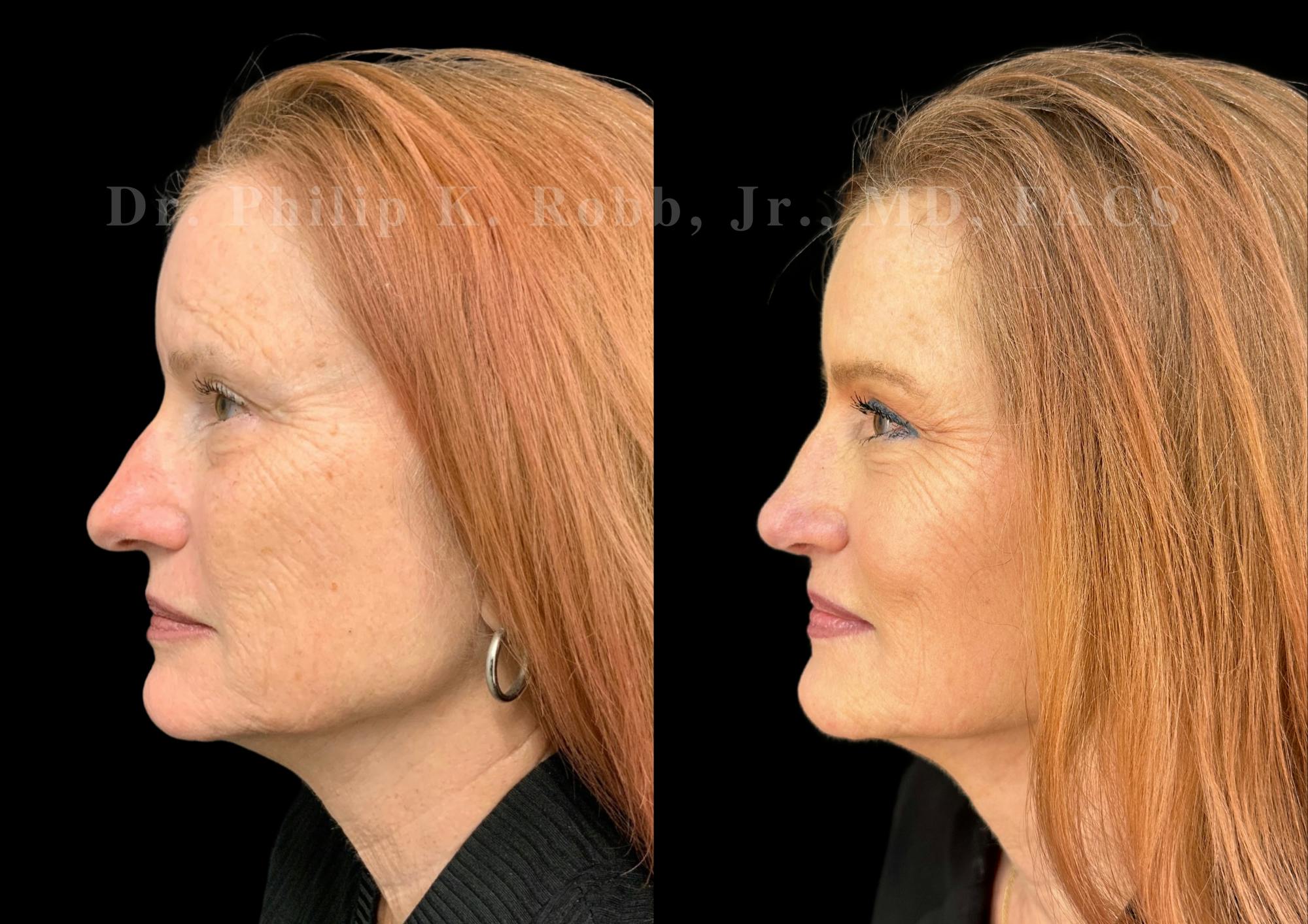 Ultrasonic Rhinoplasty Before & After Gallery - Patient 487091 - Image 5