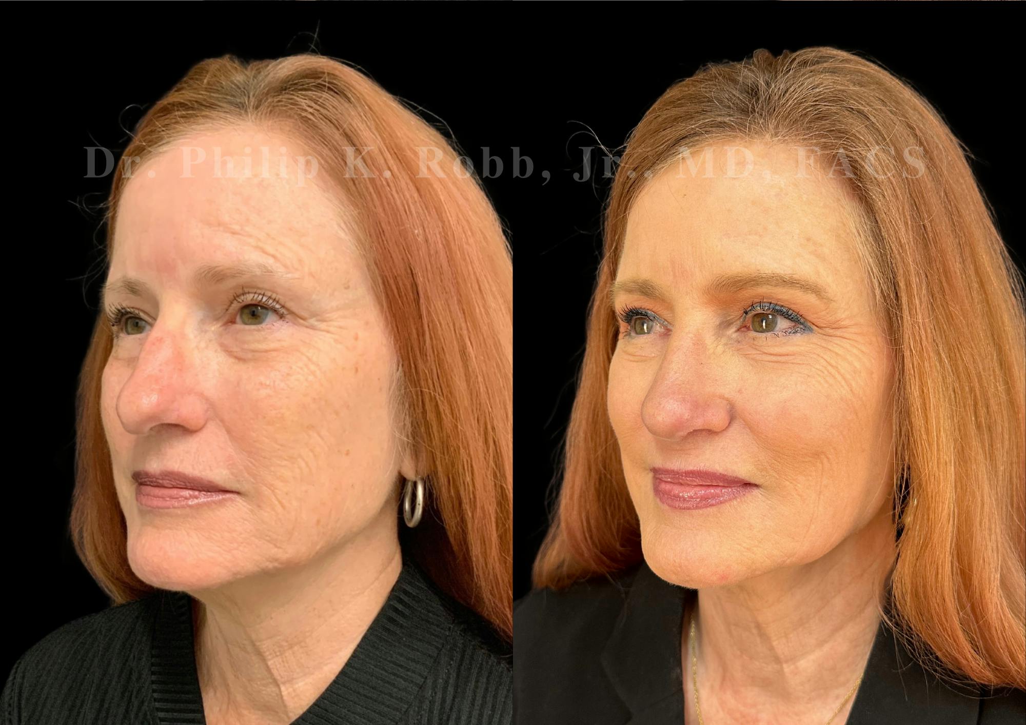 Ultrasonic Rhinoplasty Before & After Gallery - Patient 487091 - Image 4