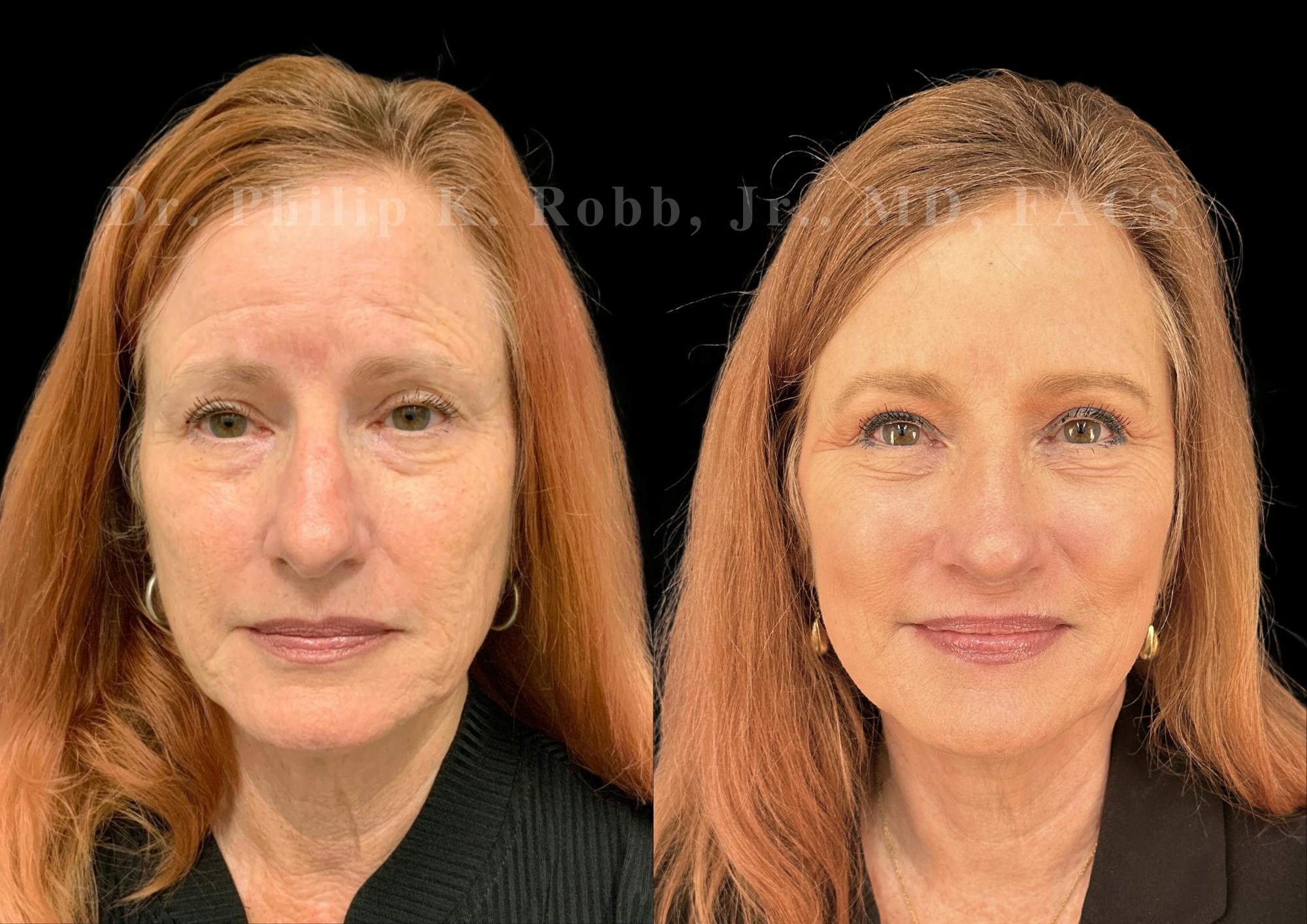 Ultrasonic Rhinoplasty Before & After Gallery - Patient 487091 - Image 3