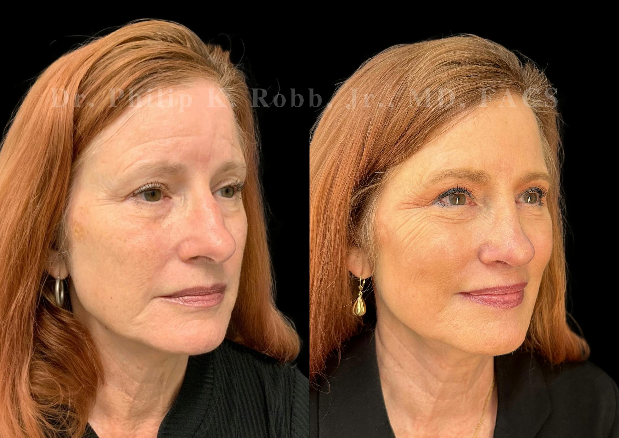 Ultrasonic Rhinoplasty Before & After Gallery - Patient 487091 - Image 2