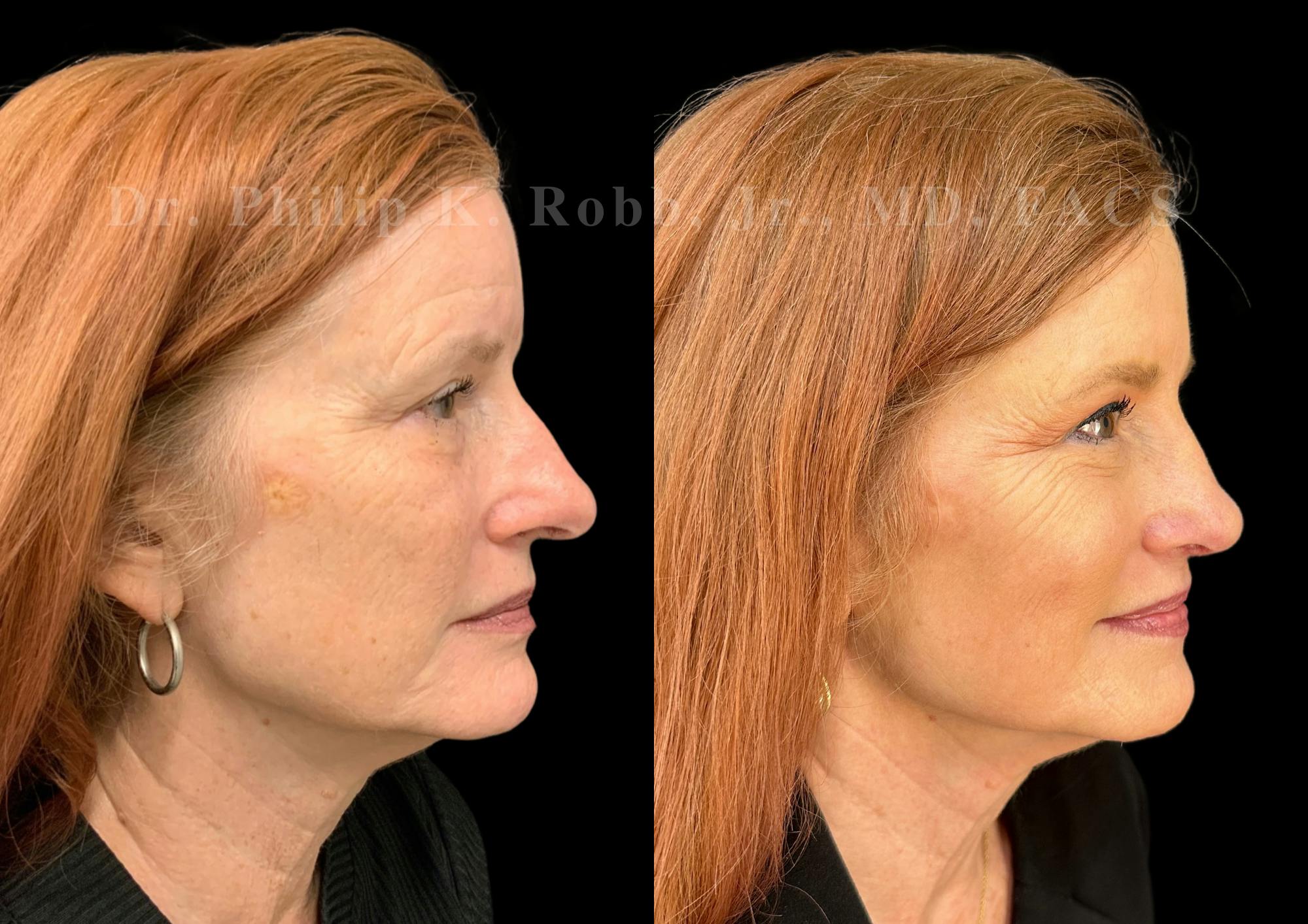 Ultrasonic Rhinoplasty Before & After Gallery - Patient 487091 - Image 1