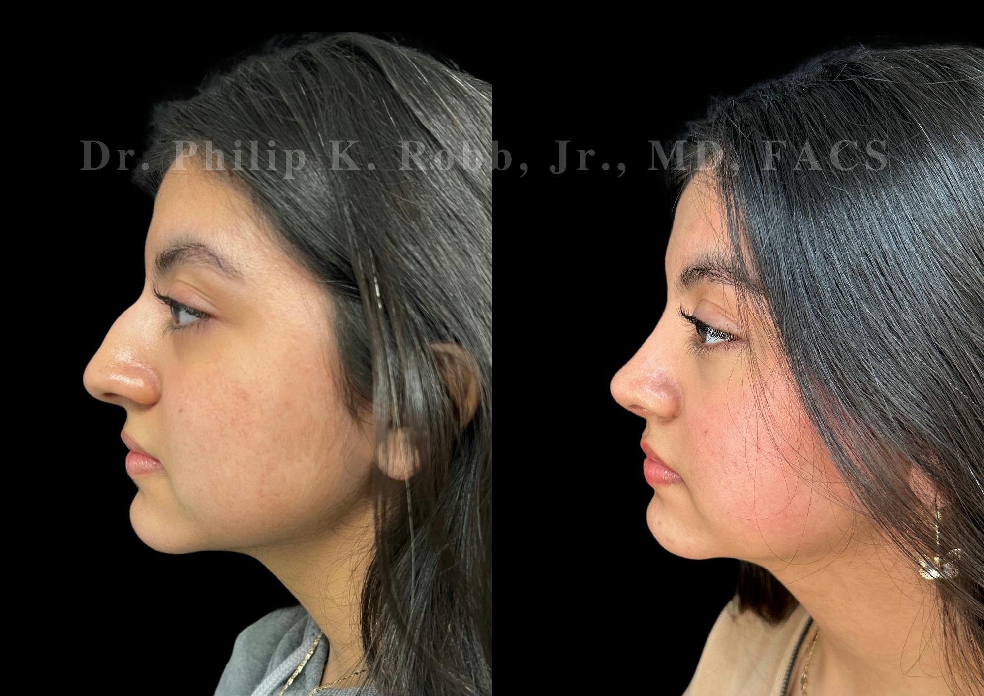 Ultrasonic Rhinoplasty Before & After Gallery - Patient 256846 - Image 5