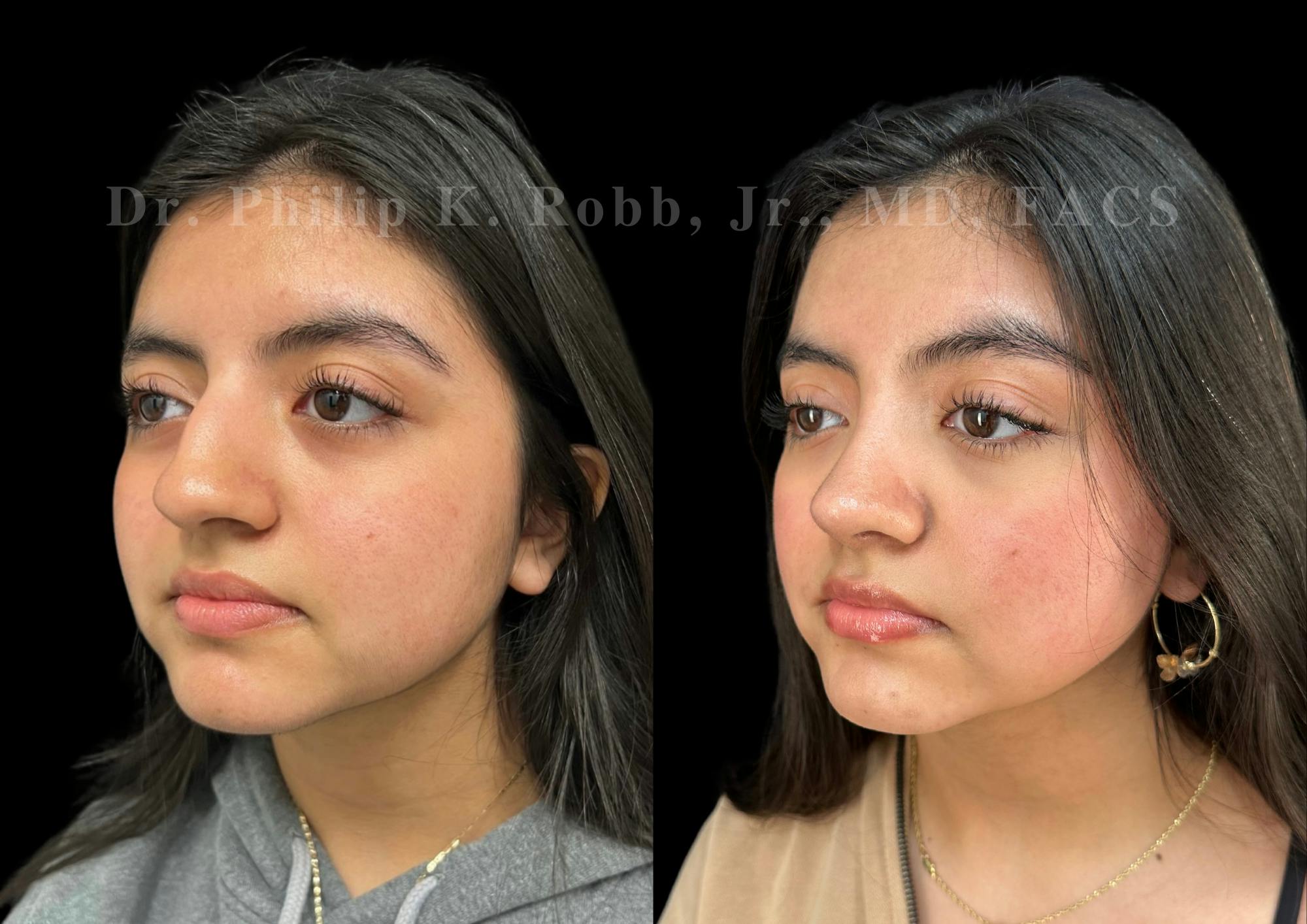 Ultrasonic Rhinoplasty Before & After Gallery - Patient 256846 - Image 4