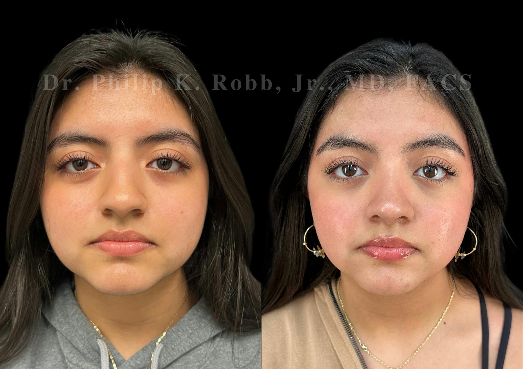 Ultrasonic Rhinoplasty Before & After Gallery - Patient 256846 - Image 3
