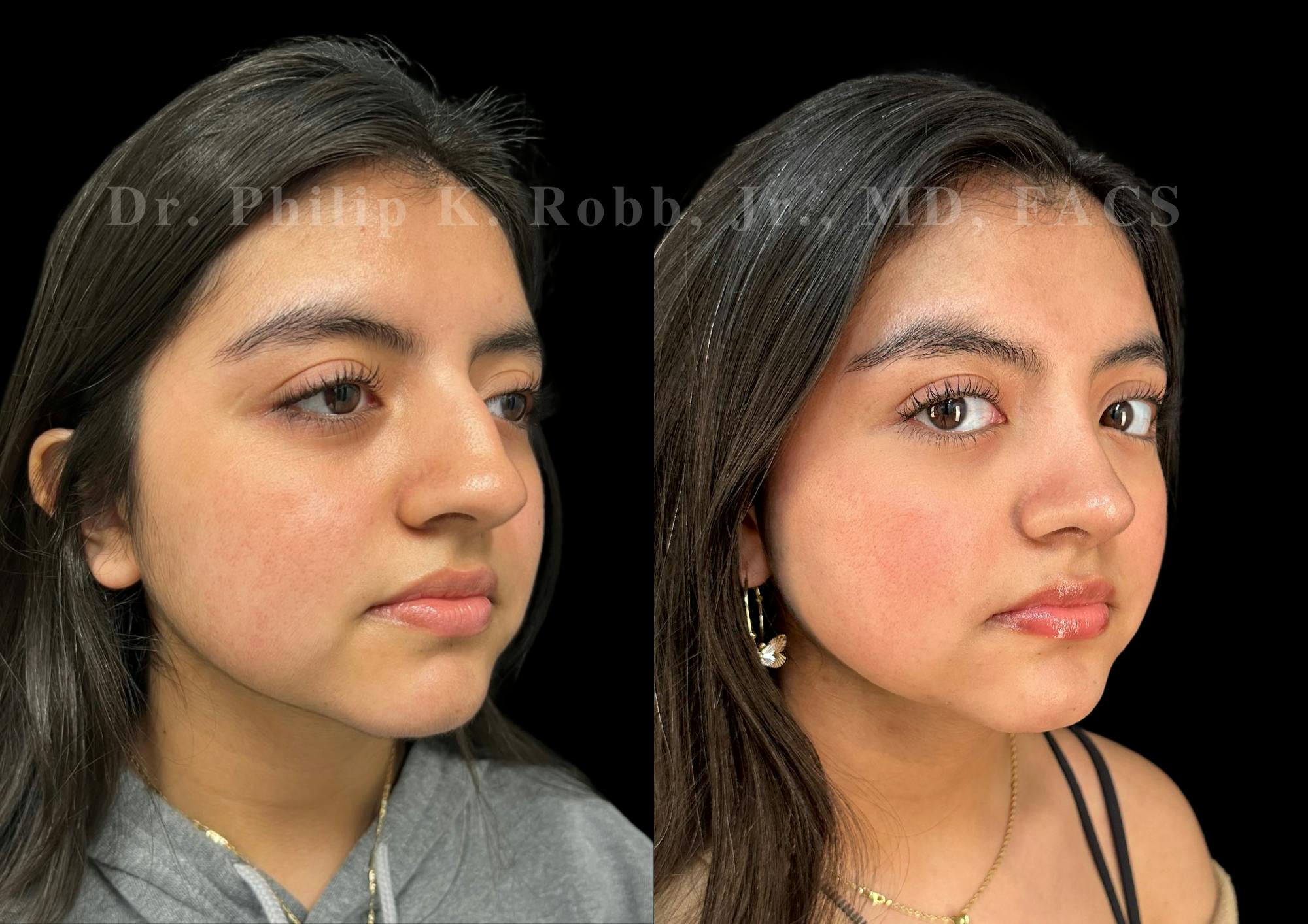Ultrasonic Rhinoplasty Before & After Gallery - Patient 256846 - Image 2