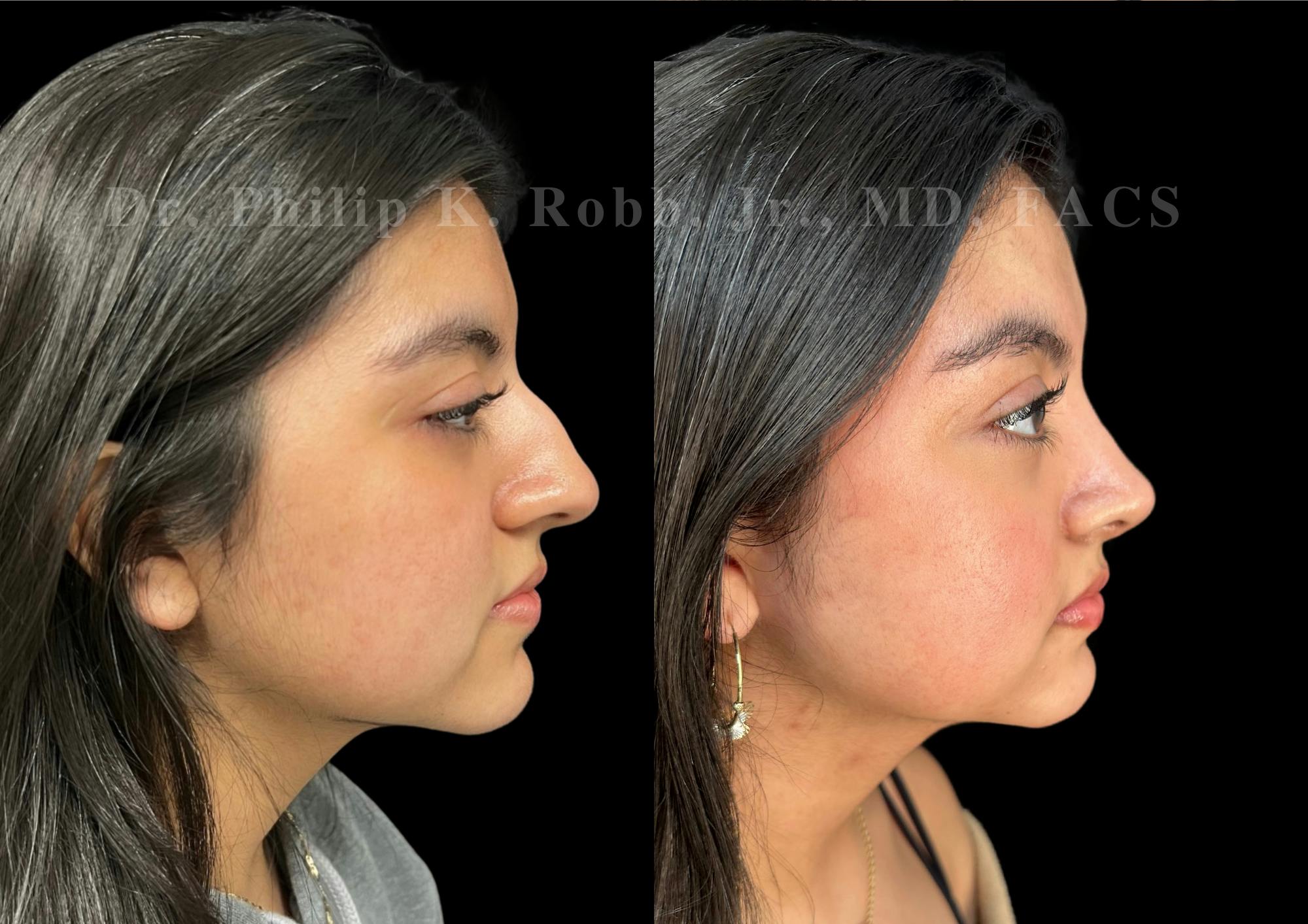 Ultrasonic Rhinoplasty Before & After Gallery - Patient 256846 - Image 1