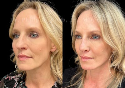 Facelift Before & After Gallery - Patient 256464 - Image 1