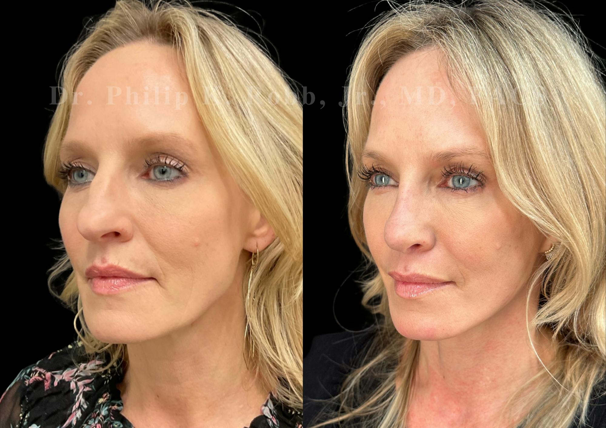 Laser Skin Resurfacing Before & After Gallery - Patient 223889 - Image 3