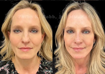 Laser Skin Resurfacing Before & After Gallery - Patient 223889 - Image 1