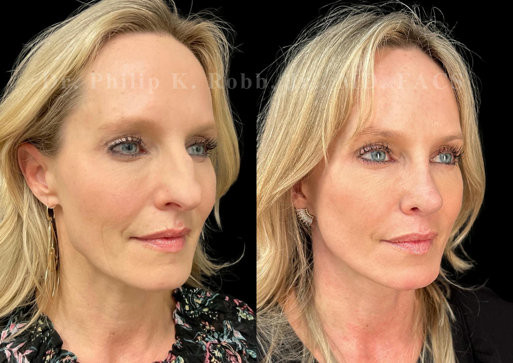 Facelift Before & After Gallery - Patient 256464 - Image 4