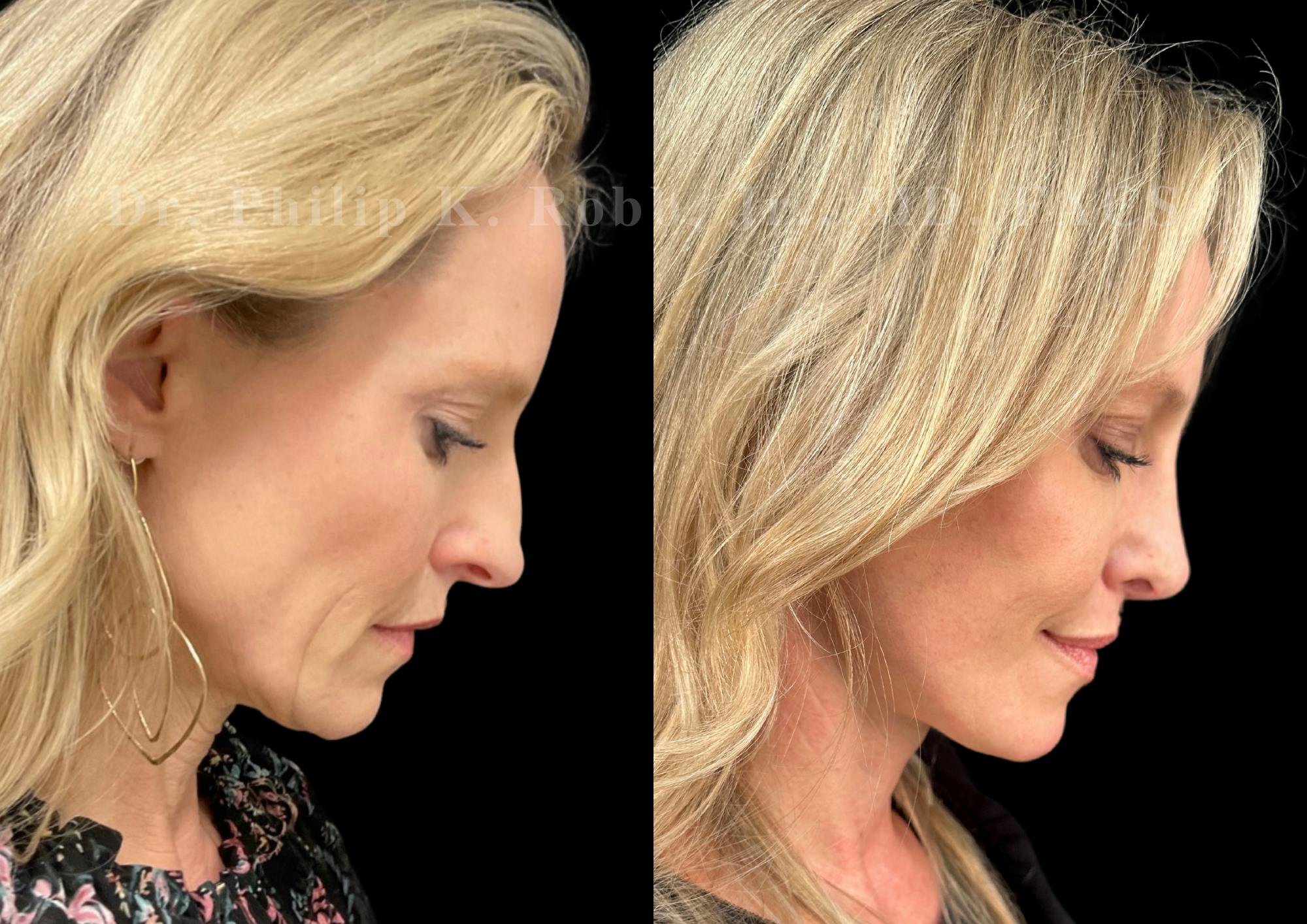 Facelift Before & After Gallery - Patient 256464 - Image 6