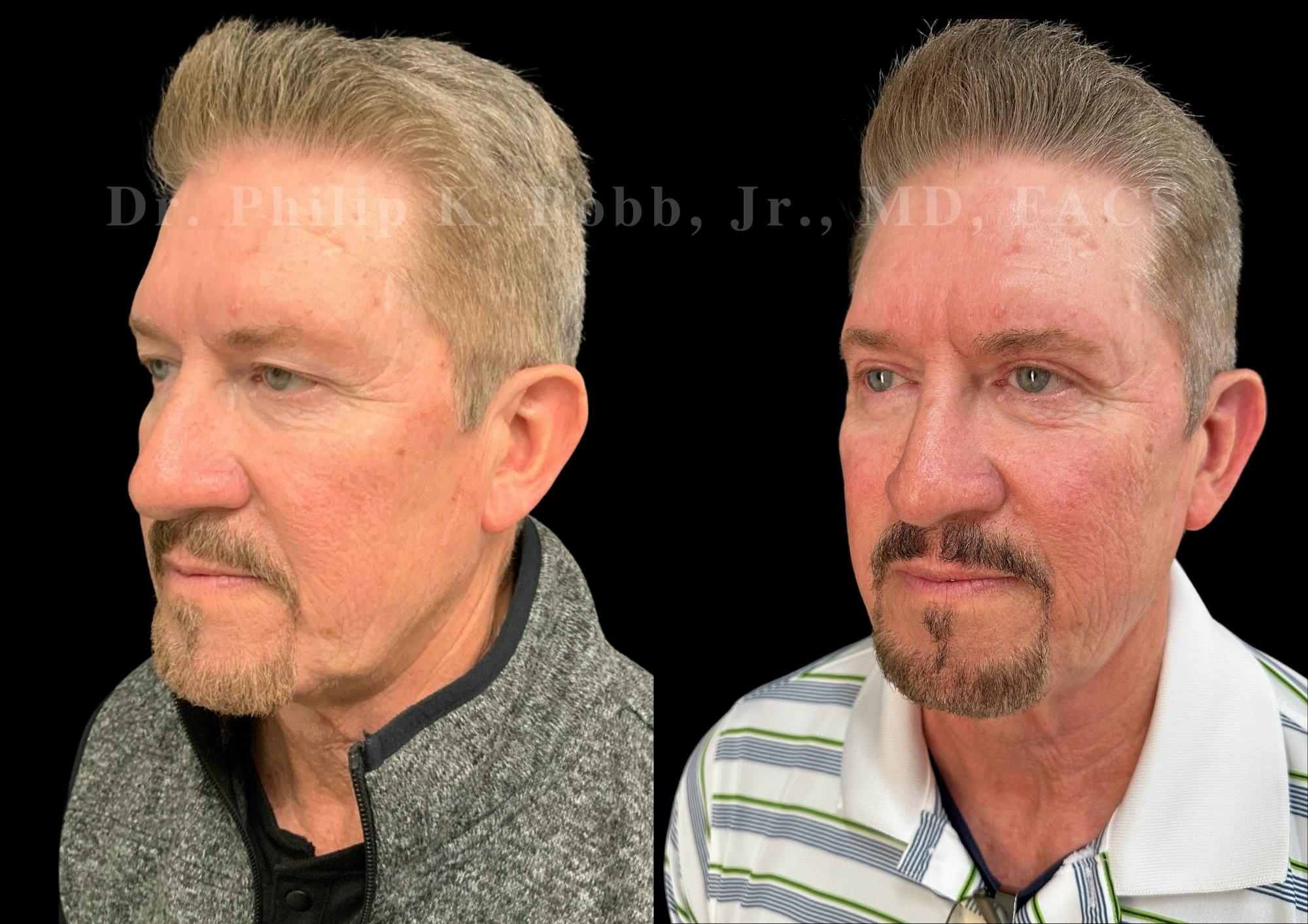 Upper Blepharoplasty Before & After Gallery - Patient 127590 - Image 2