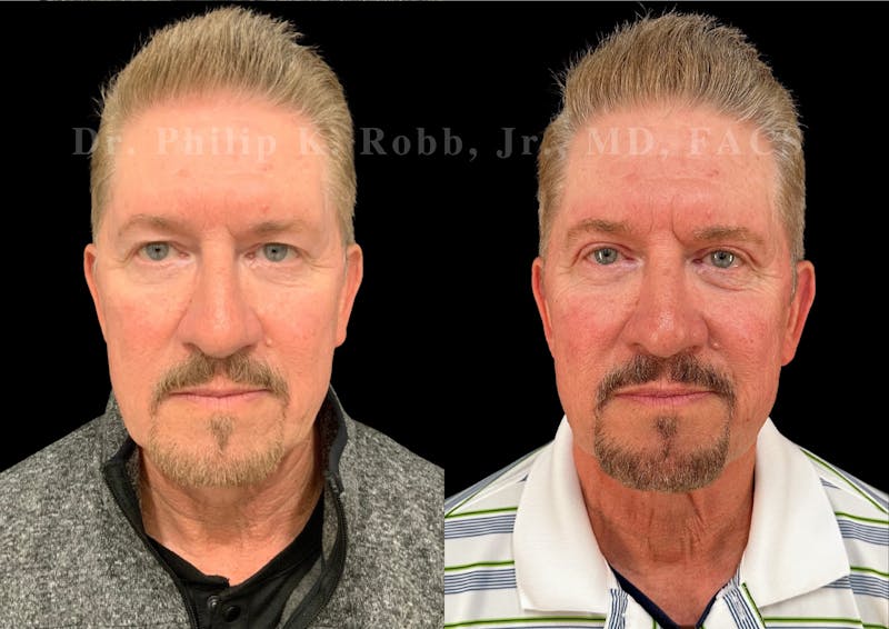 Upper Blepharoplasty