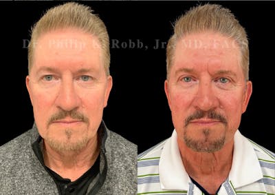 Upper Blepharoplasty Before & After Gallery - Patient 127590 - Image 1