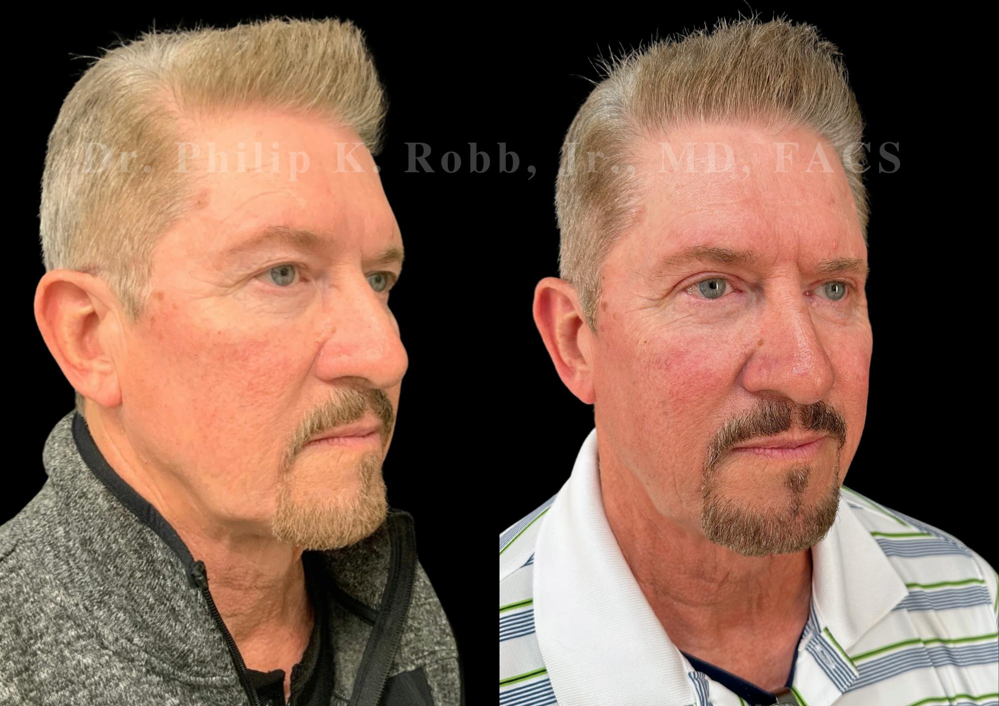 Upper Blepharoplasty Before & After Gallery - Patient 127590 - Image 3