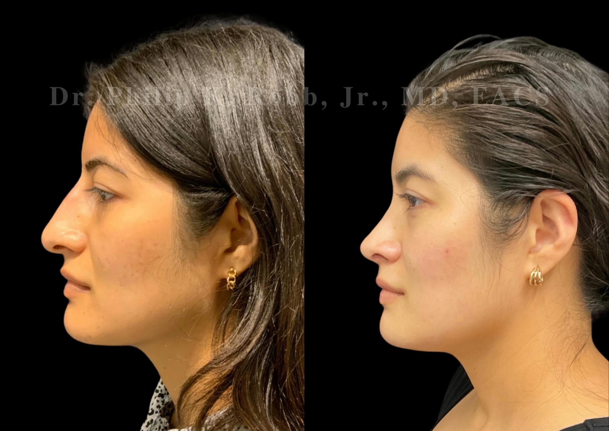 Ultrasonic Rhinoplasty Before & After Gallery - Patient 235995 - Image 5