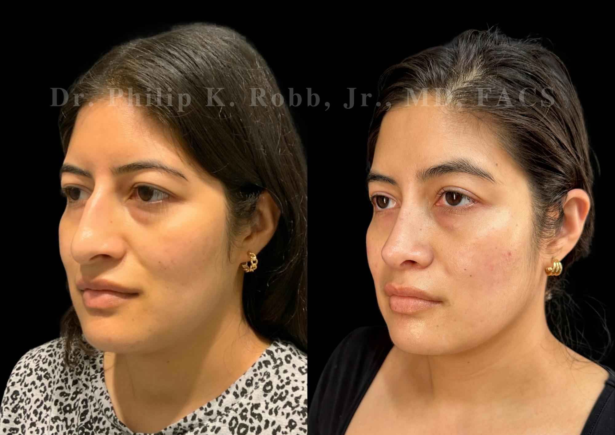 Ultrasonic Rhinoplasty Before & After Gallery - Patient 235995 - Image 4