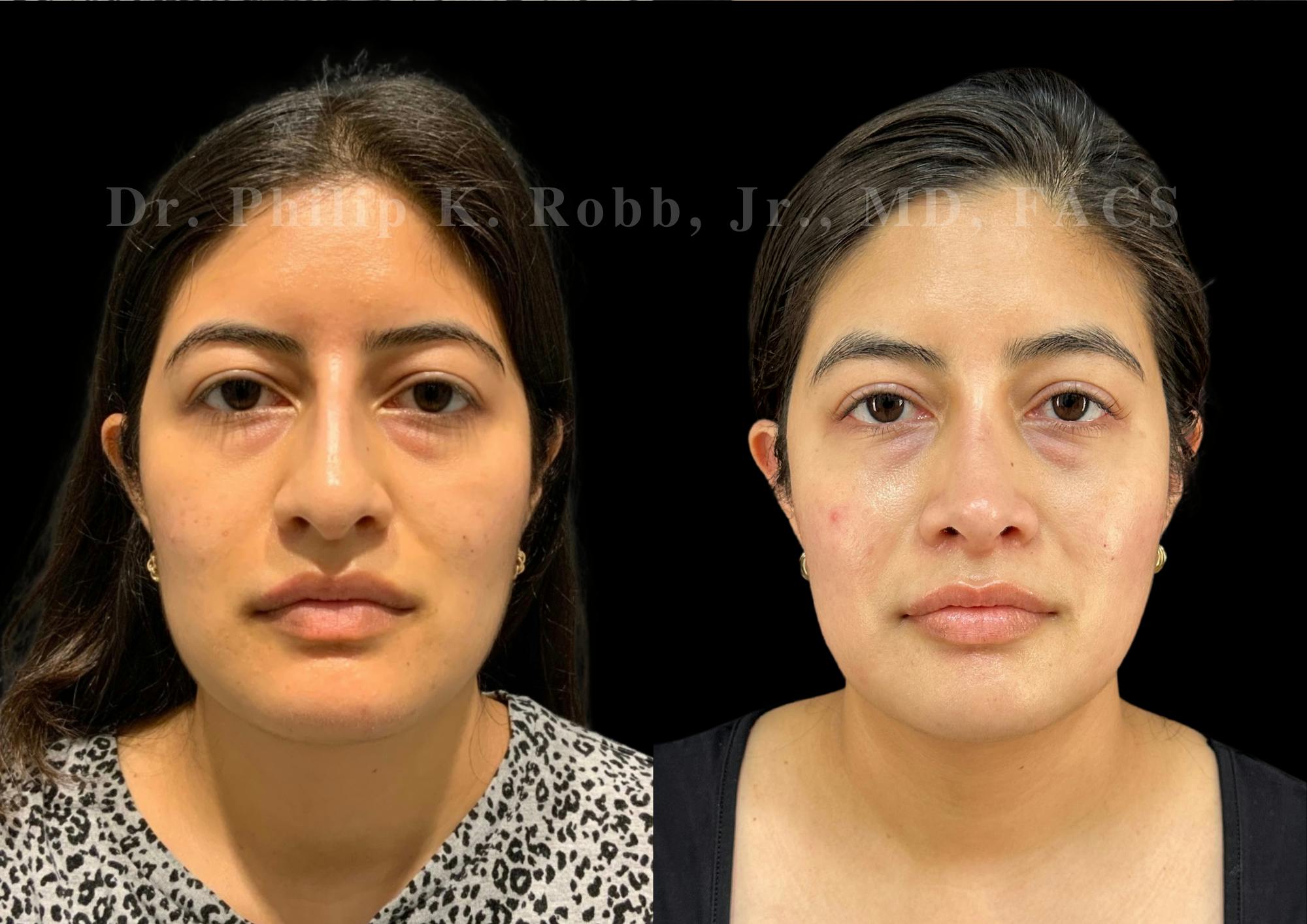 Ultrasonic Rhinoplasty Before & After Gallery - Patient 235995 - Image 3
